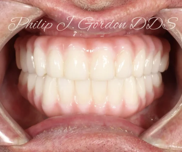Dental-implants-Kansas-City-Before-and-after