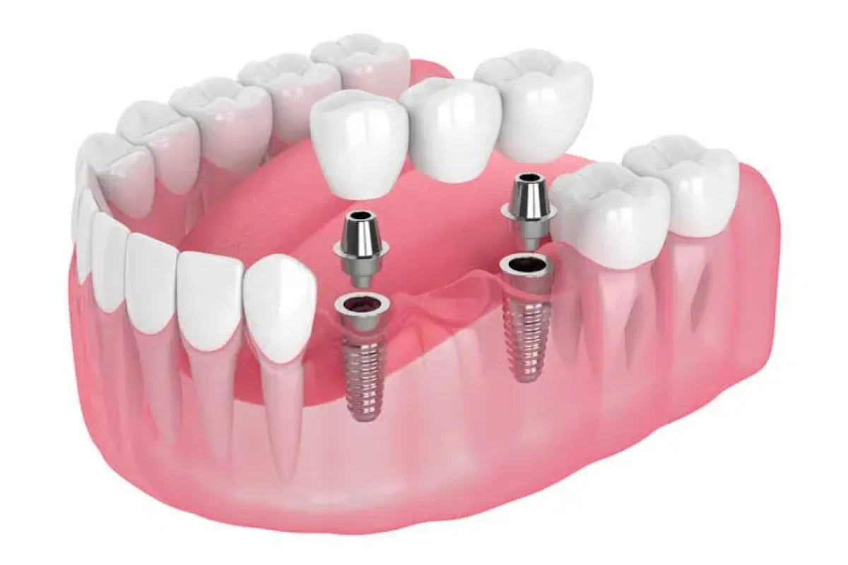 Dental implants by Philip J Gordon DBSPA in Leawood, KS