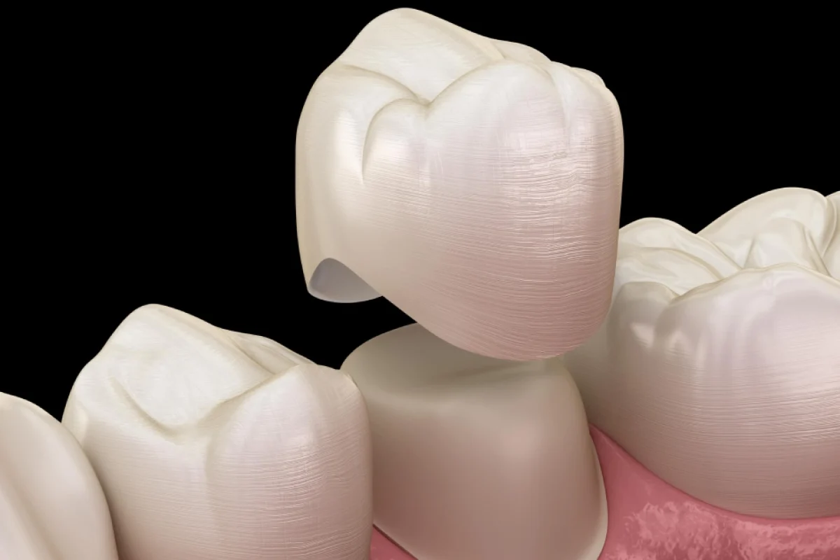 Detailed 3D illustration of a porcelain dental crown being placed over a prepared tooth stump, representing Full-Mouth Crowns in Kansas City.