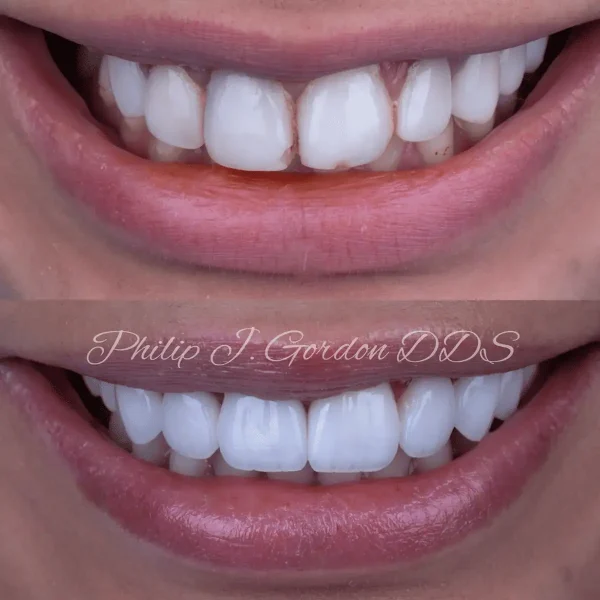 Full-Mouth Crowns in Kansas City