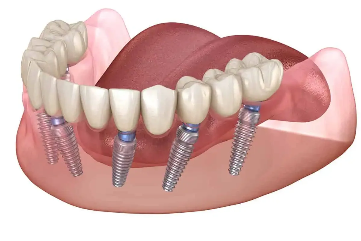 Full Mouth Dental Implants in Kansas City, KS