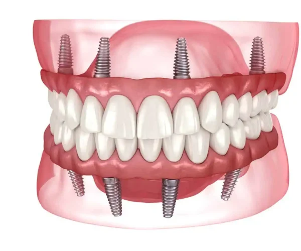 Full Mouth Implants Kanas City, KS at Gordon Dental Implants and Cosmetics