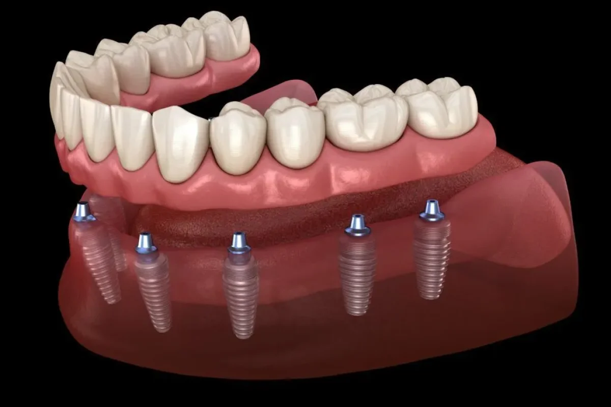 Full Mouth Implants in Kansas City, KS