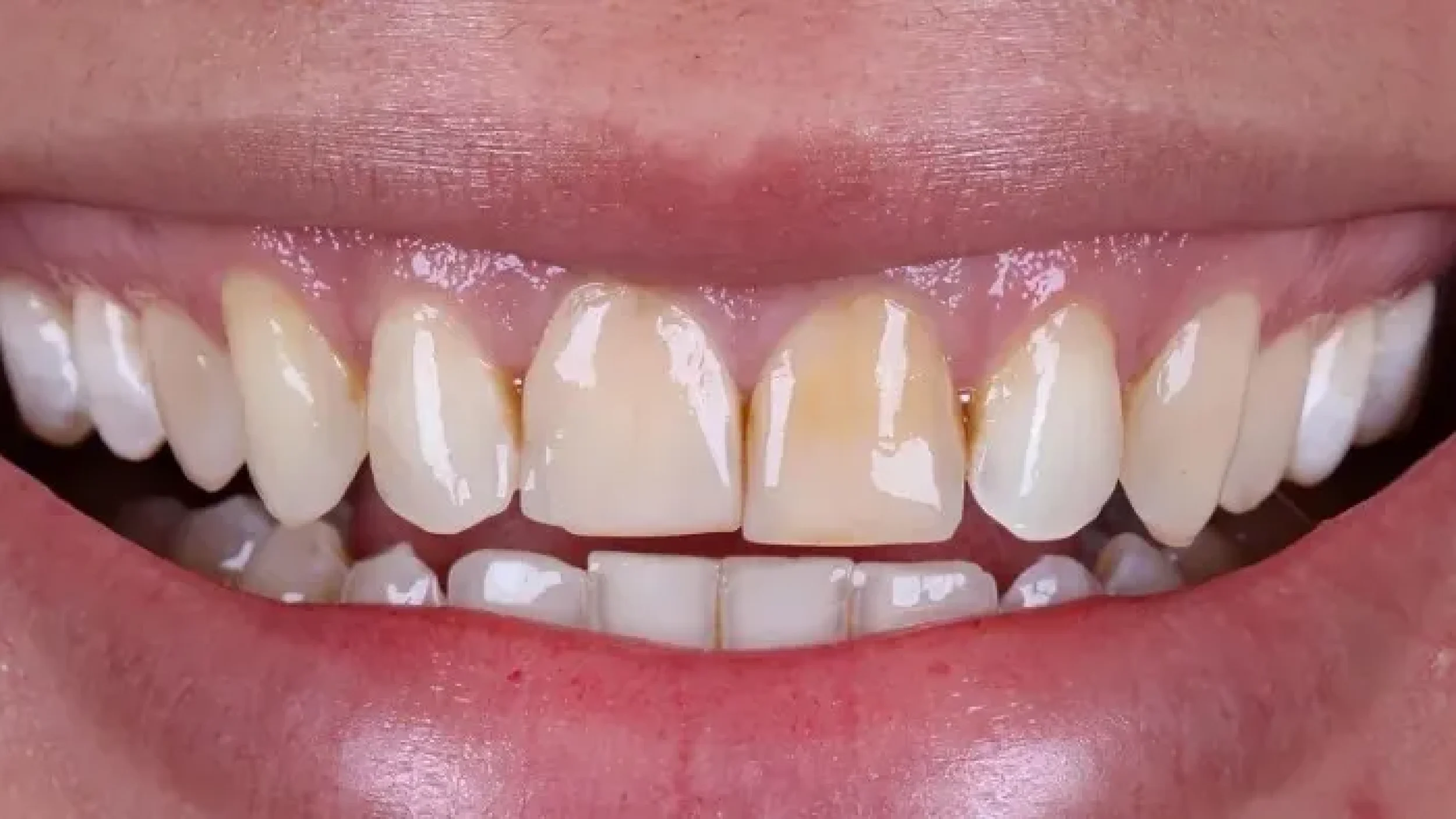Gordon Dental Implants And Cosmetics Before After AAA