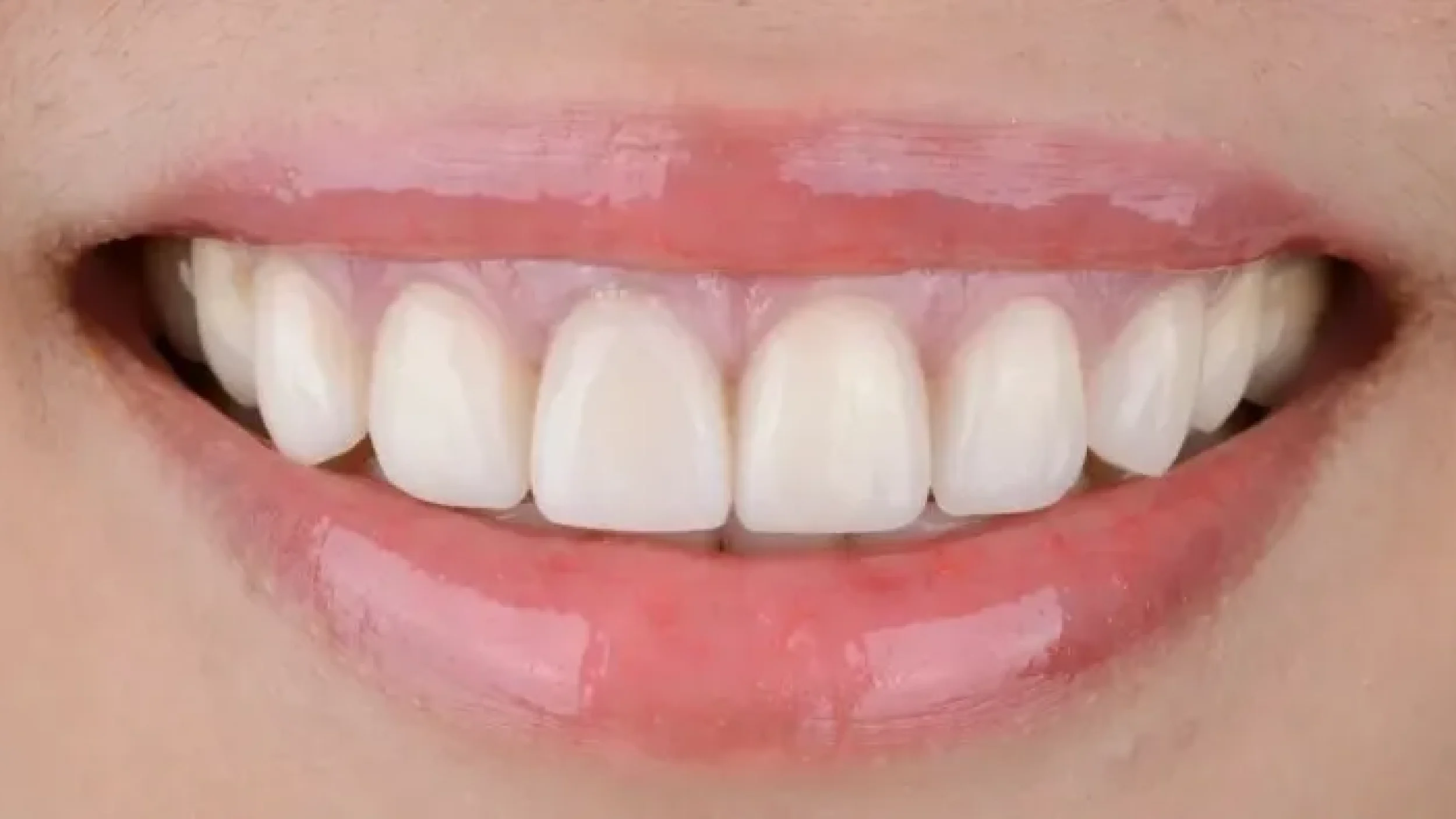 Gordon Dental Implants And Cosmetics Before After CCC