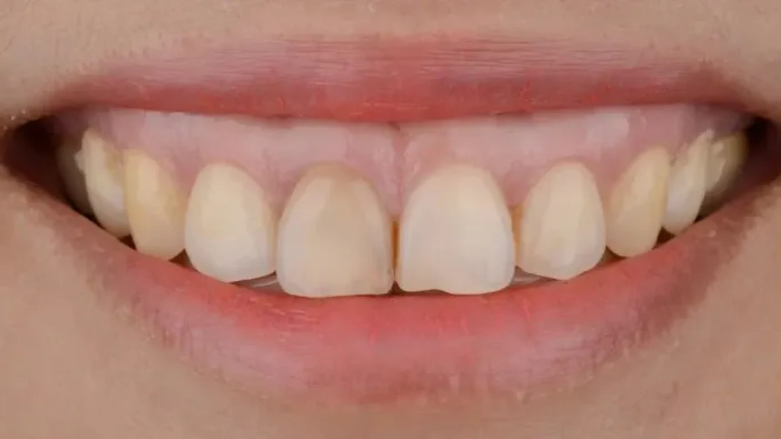 Porcelain Veeners Before After DDD at Gordon Dental Implants and Cosmetics
