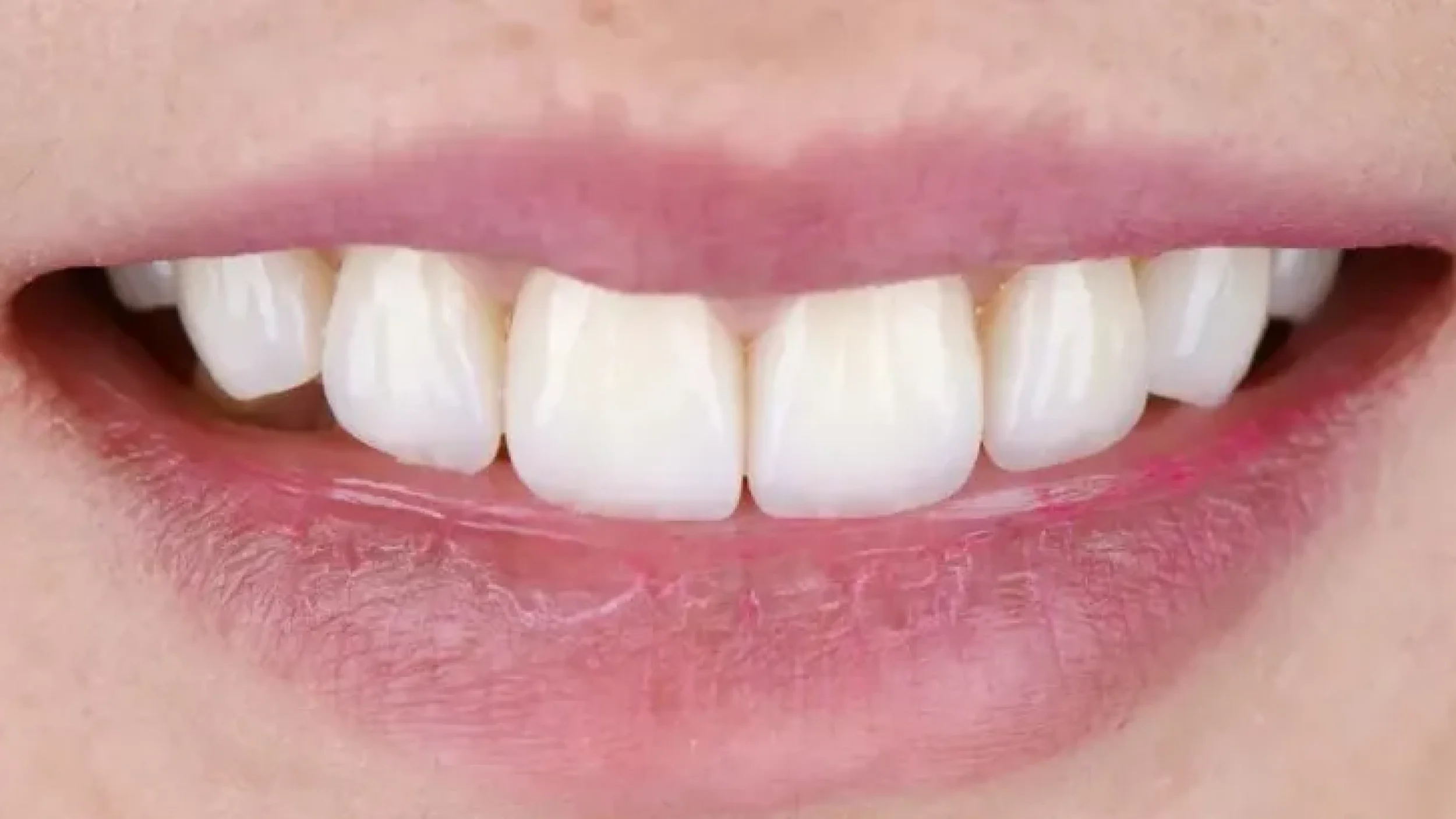 Gordon Dental Implants And Cosmetics Before After EEE