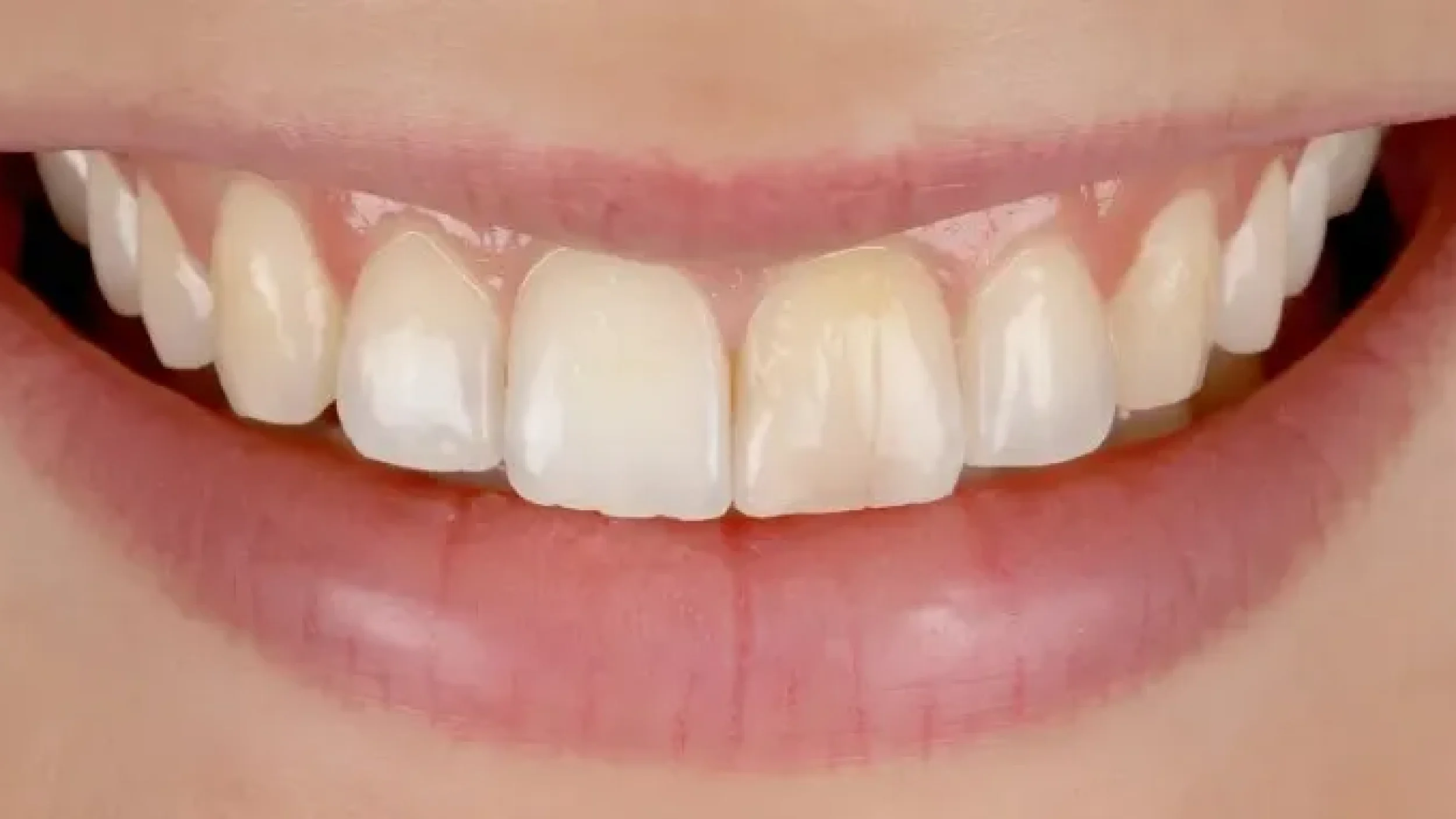 Gordon Dental Implants And Cosmetics porcelain veneer Before After GGG
