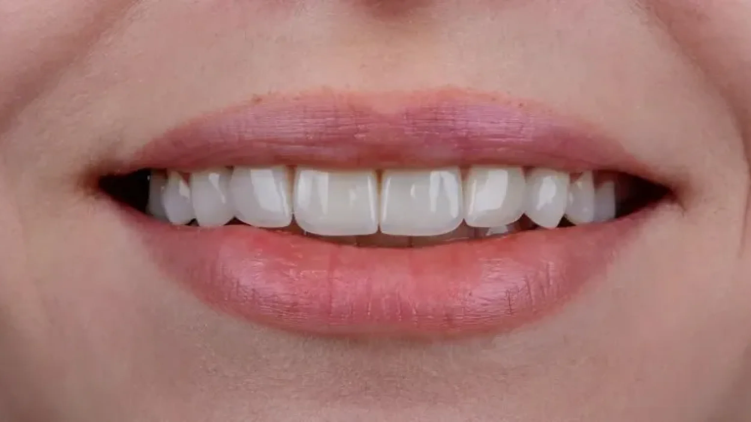 Gordon Dental Implants And Cosmetics Before After JJJ