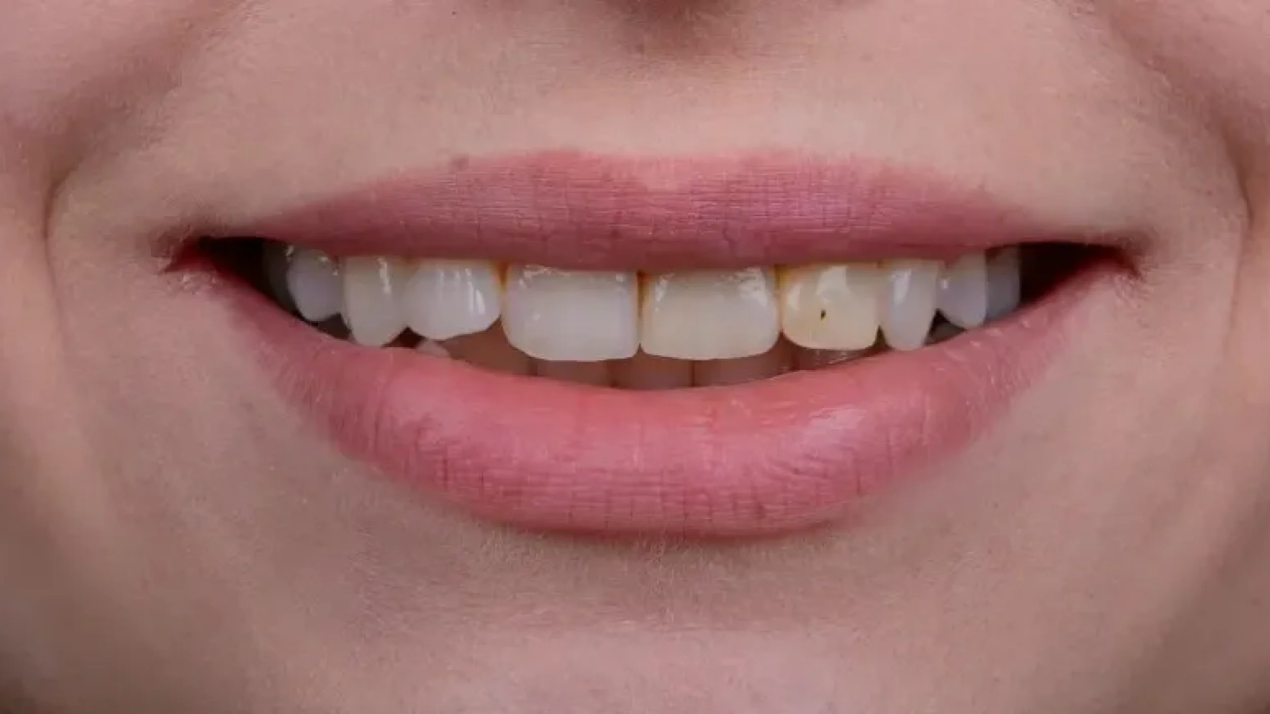 Gordon Dental Implants And Cosmetics porcelain veneer Before After KKK