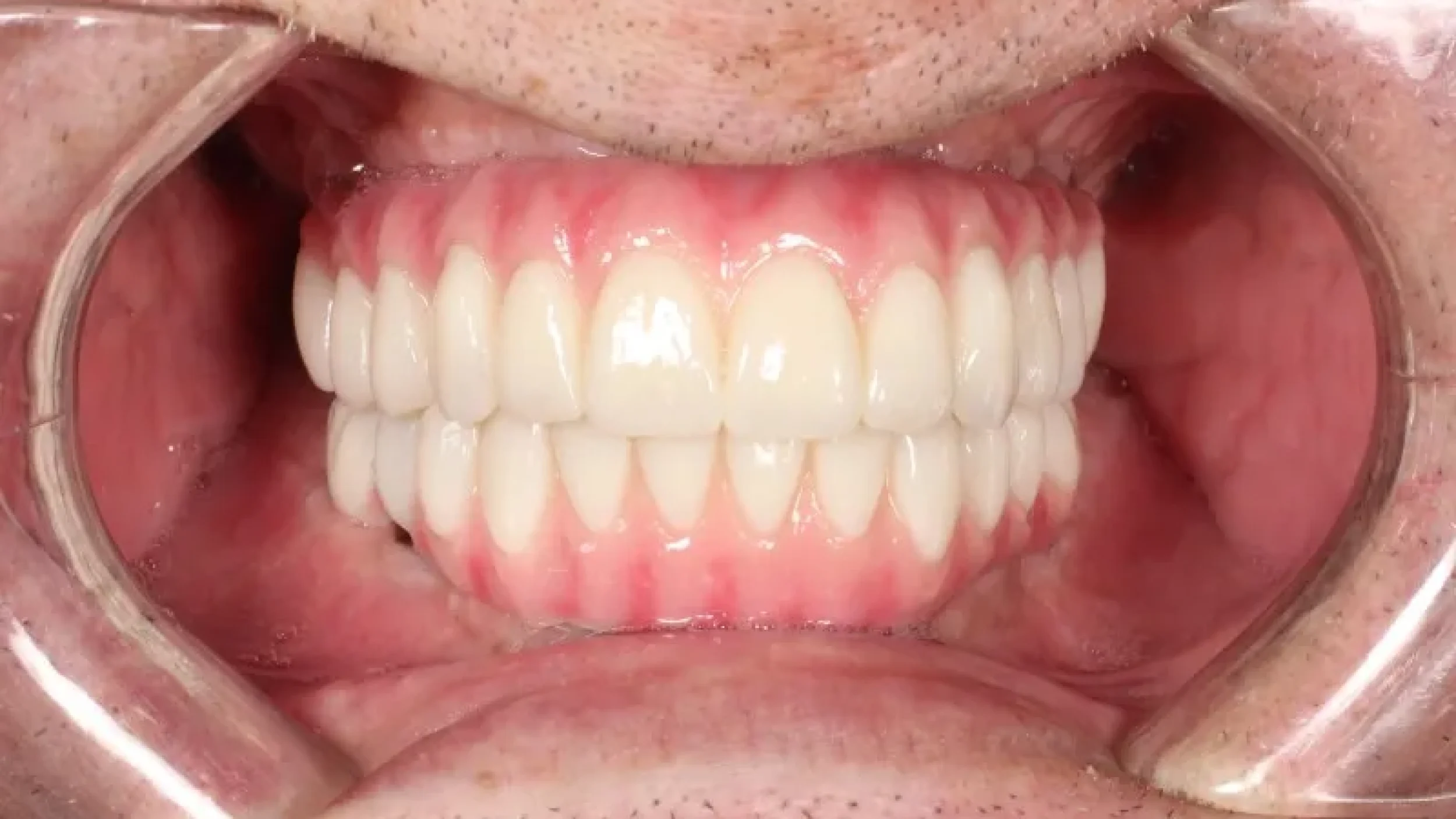 Gordon Dental Implants And Cosmetics Before After MMM