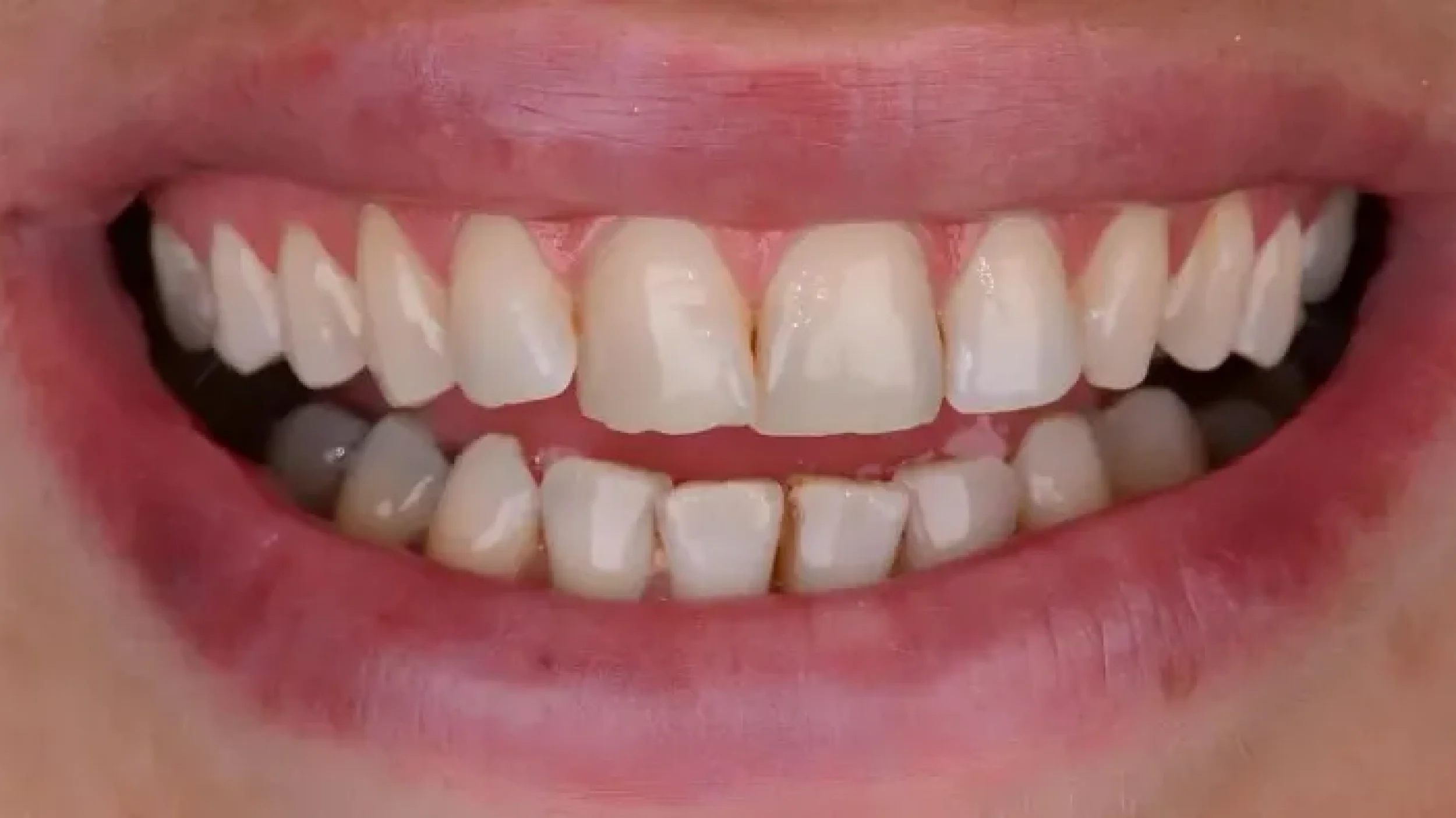 Gordon Dental Implants And Cosmetics porcelain veneers Before After PPP