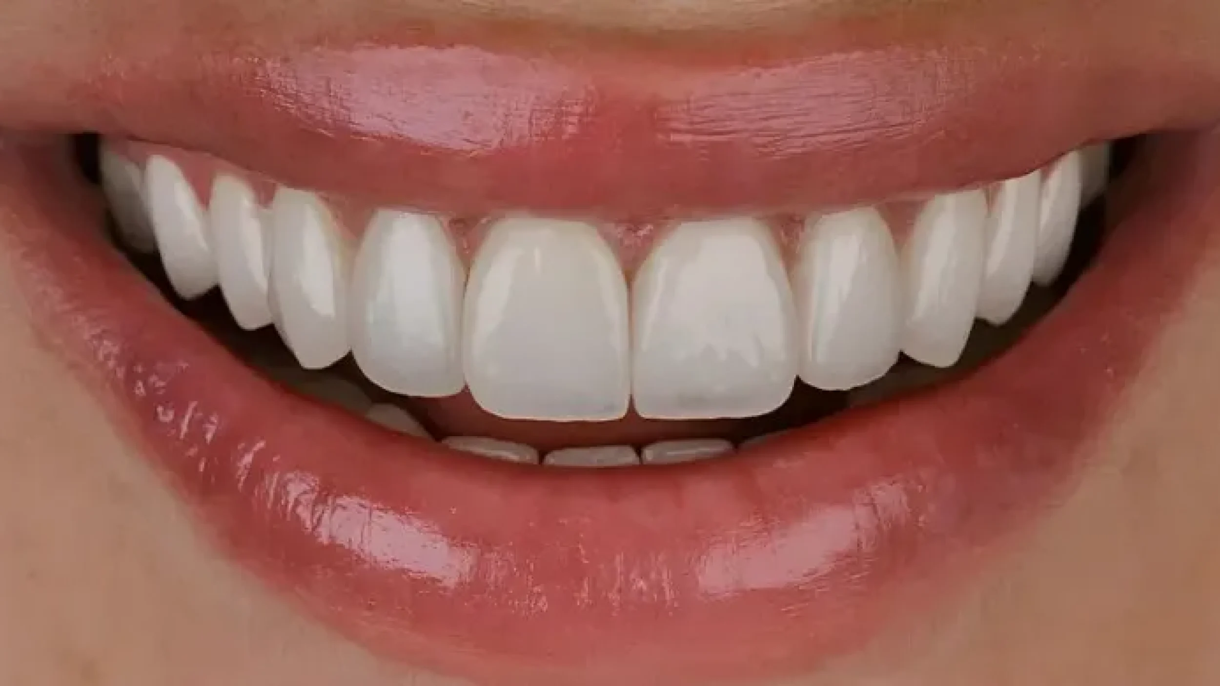 Gordon Dental Implants And Cosmetics Before After QQQ