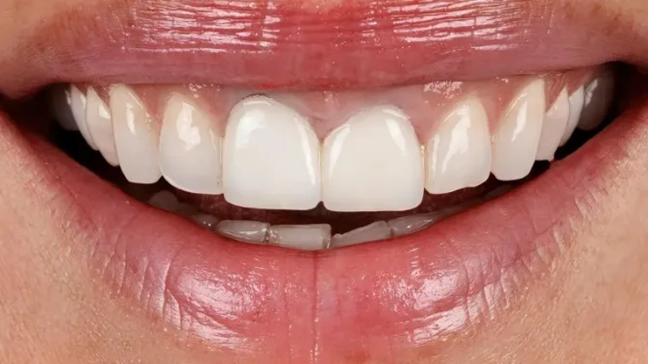 Gordon Dental Implants And Cosmetics porcelain veneer treatment Before After RRR