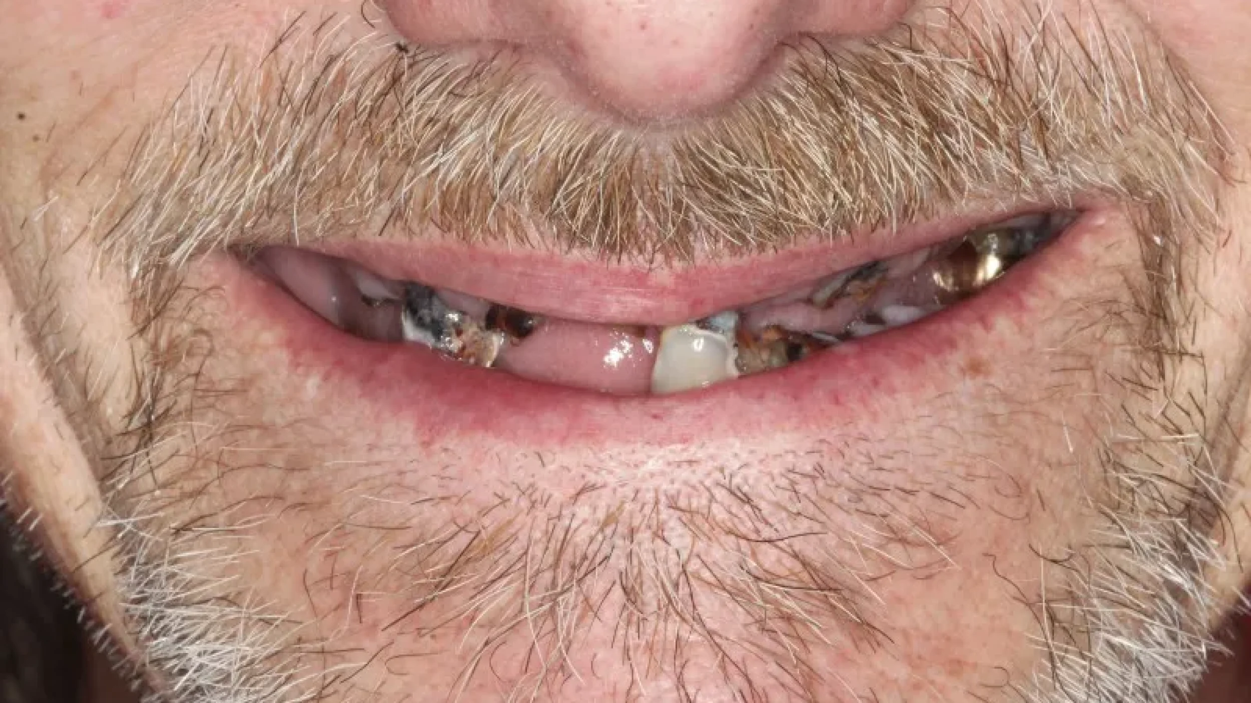 Gordon Dental Implants and Cosmetics Before After A