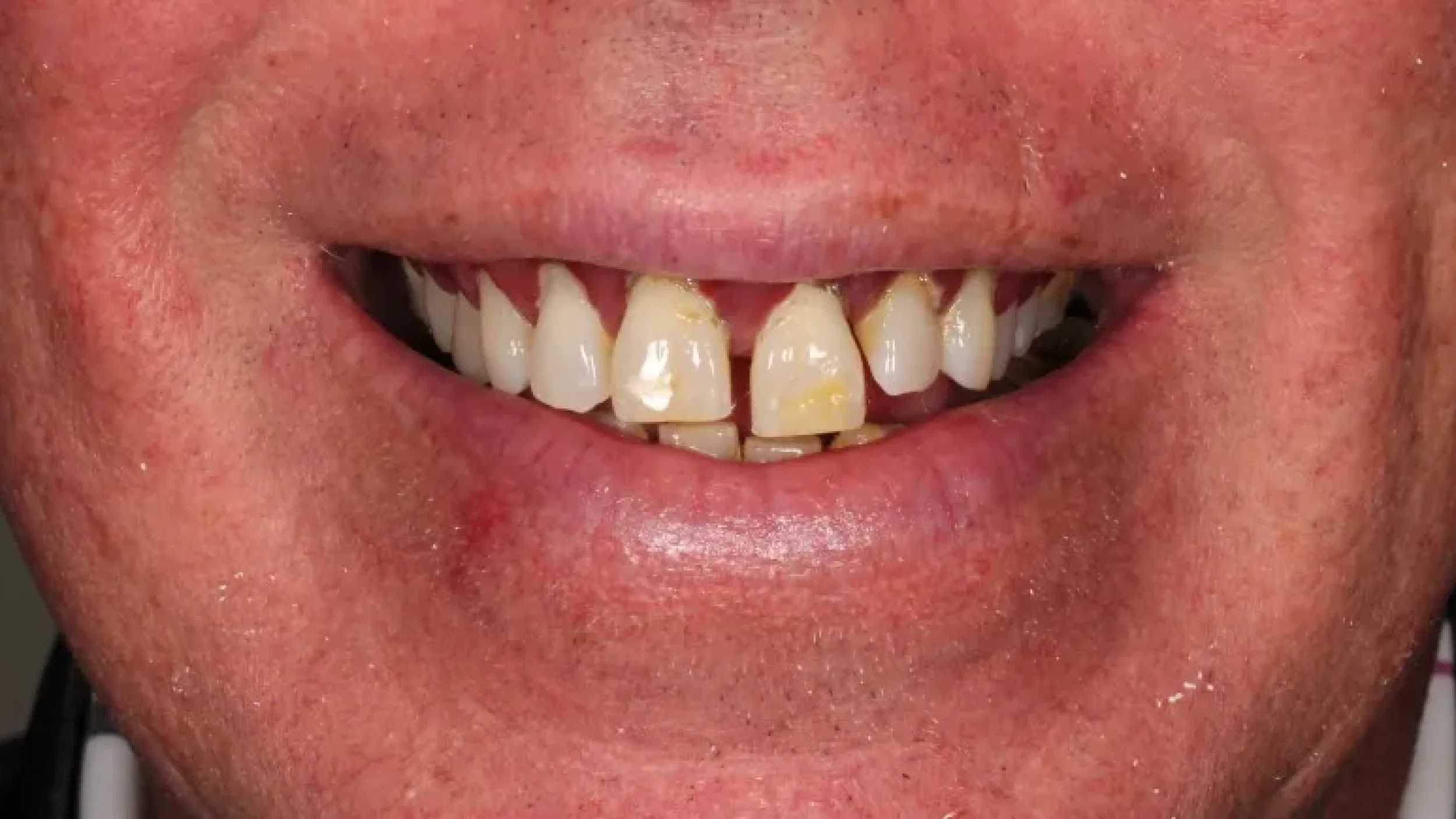 Gordon Dental Implants and Cosmetics Before After AA