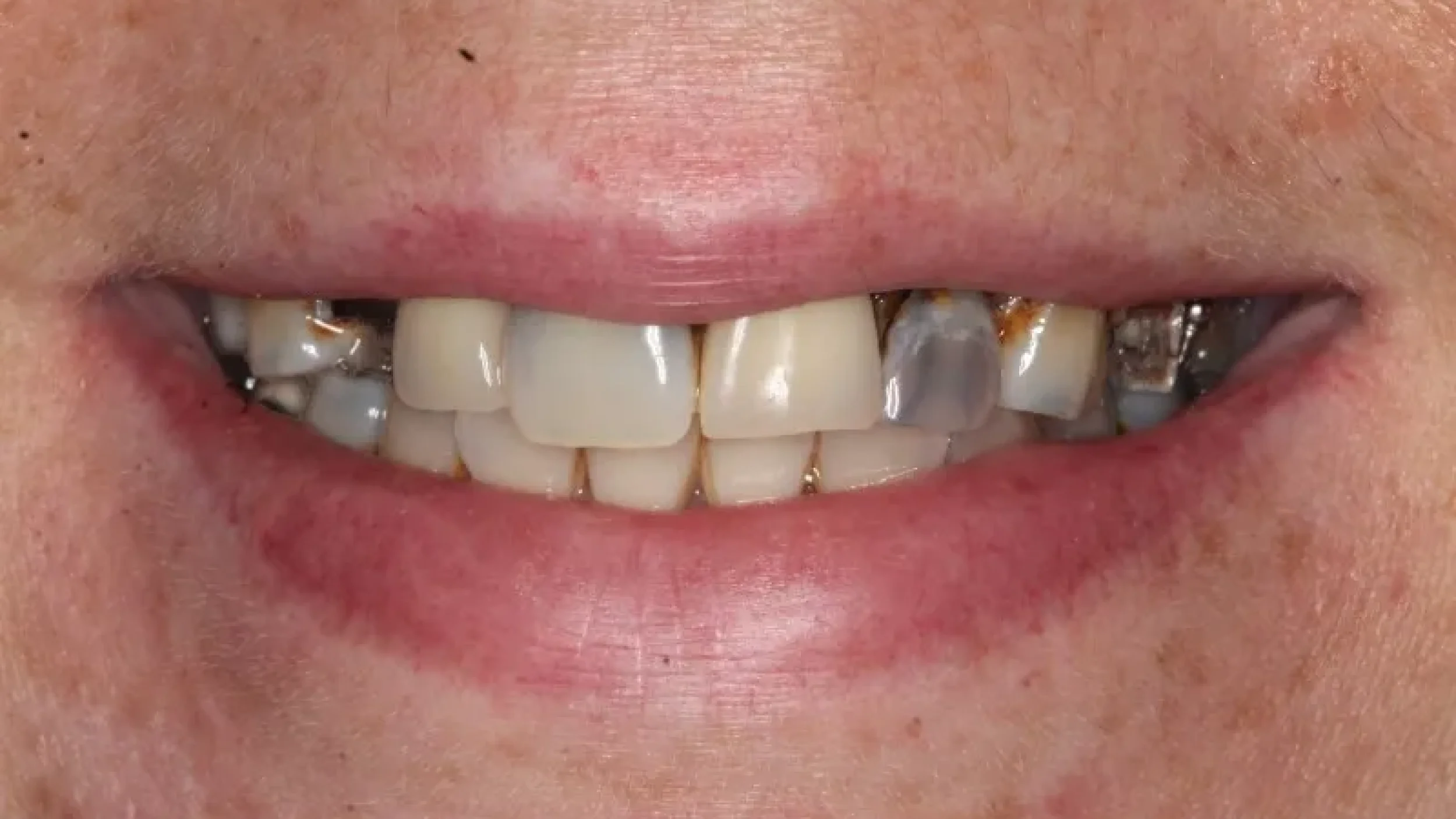 Gordon Dental Implants and Cosmetics Before After B