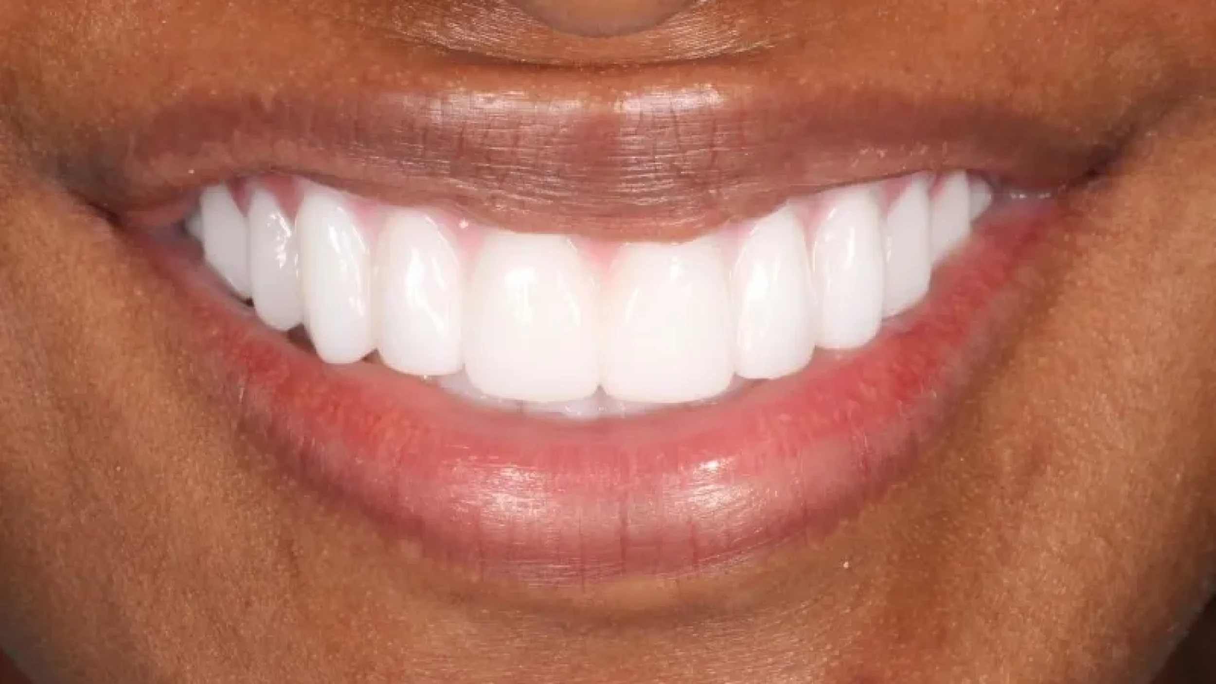 Gordon Dental Implants and Cosmetics Before After BB