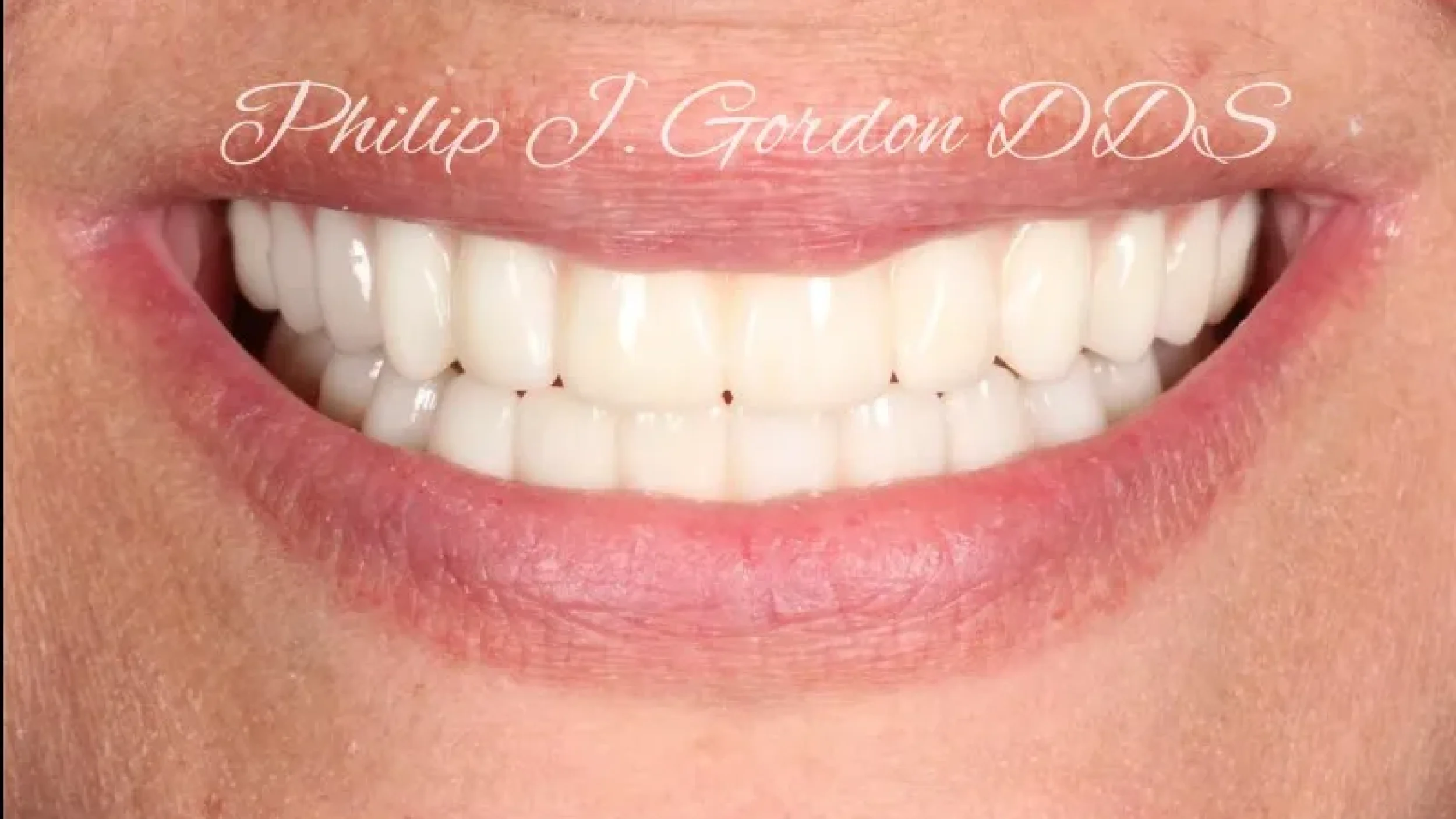 Gordon Dental Implants and Cosmetics Before After C