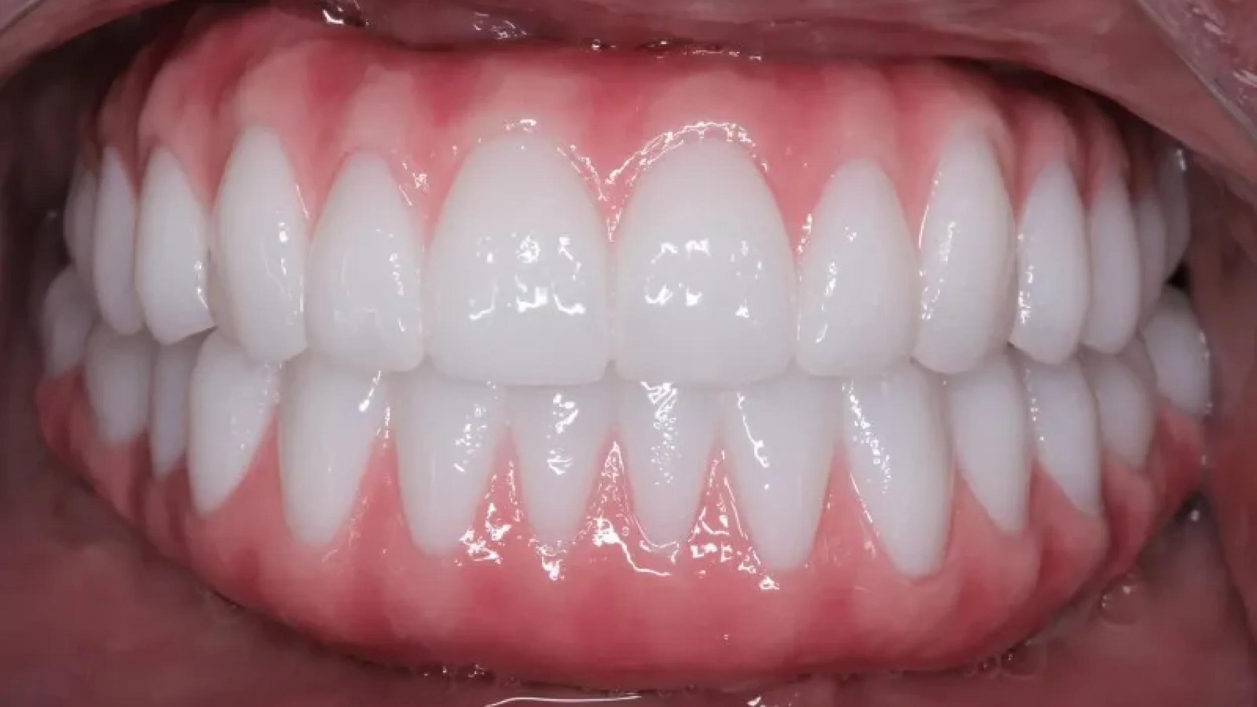 Gordon Dental Implants and Cosmetics Before After CC