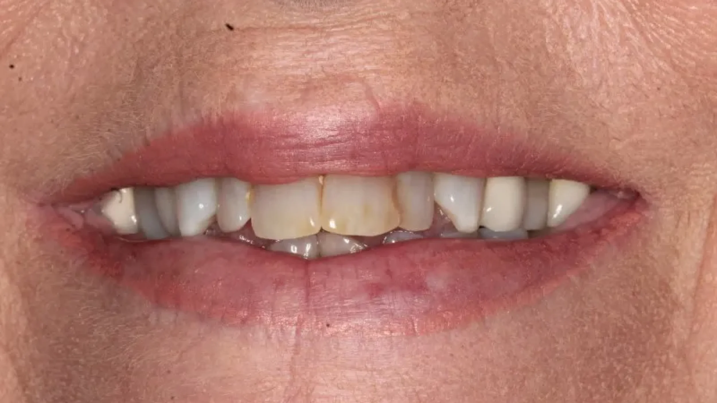 Gordon Dental Implants and Cosmetics Before After D