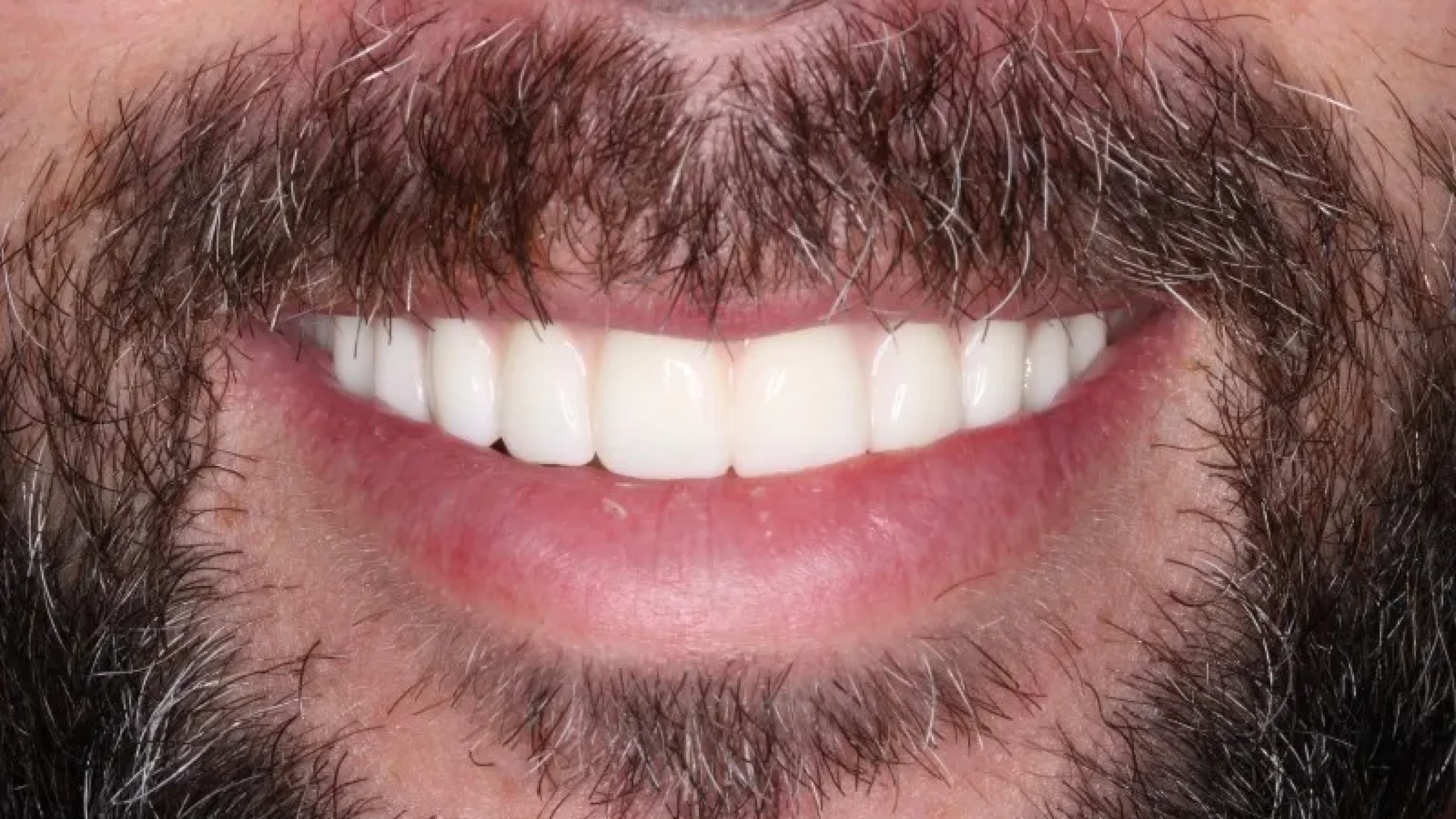 Gordon Dental Implants and Cosmetics Before After E