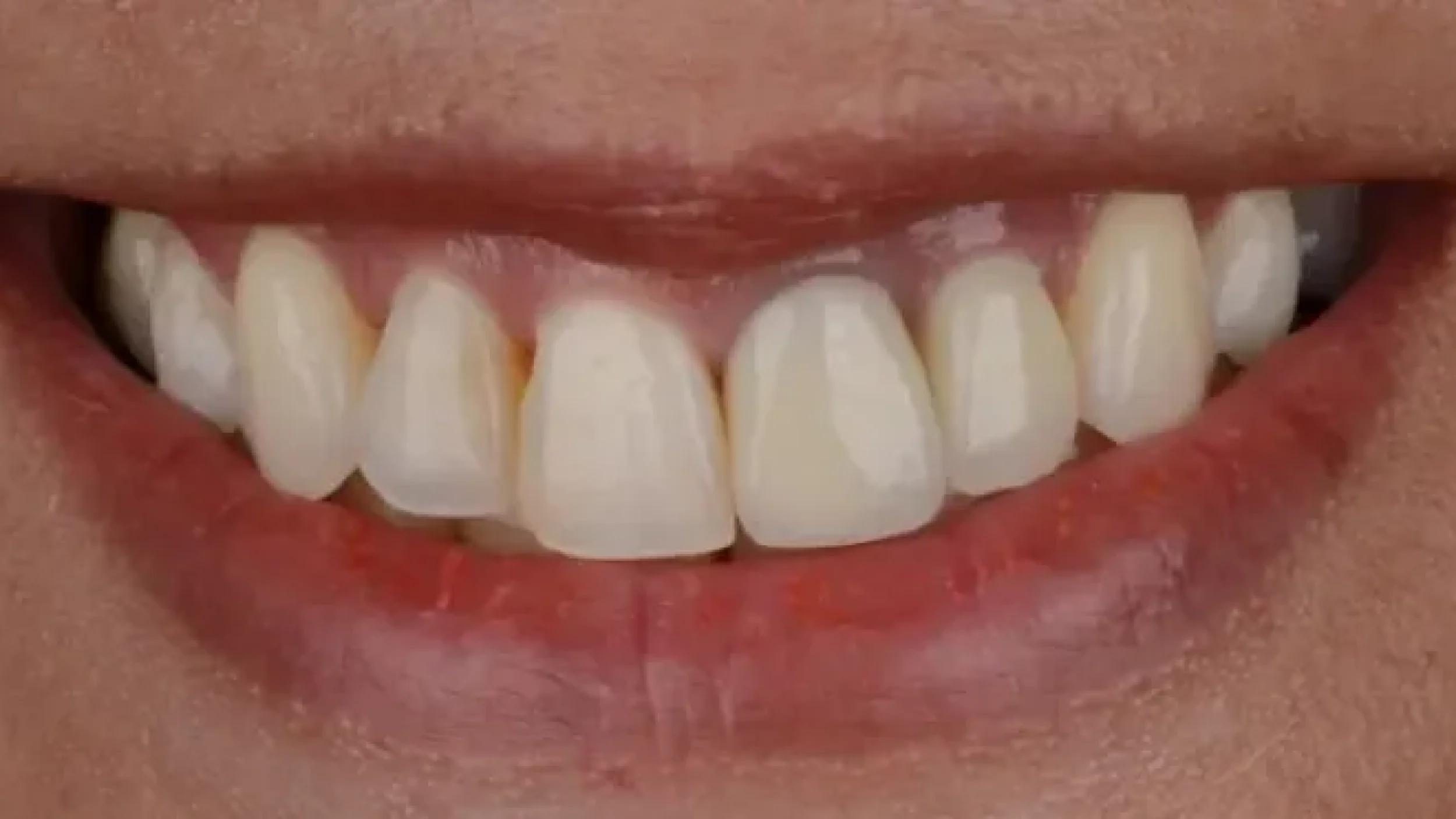 Porcelain Veeners Before After EE at Gordon Dental Implants and Cosmetics