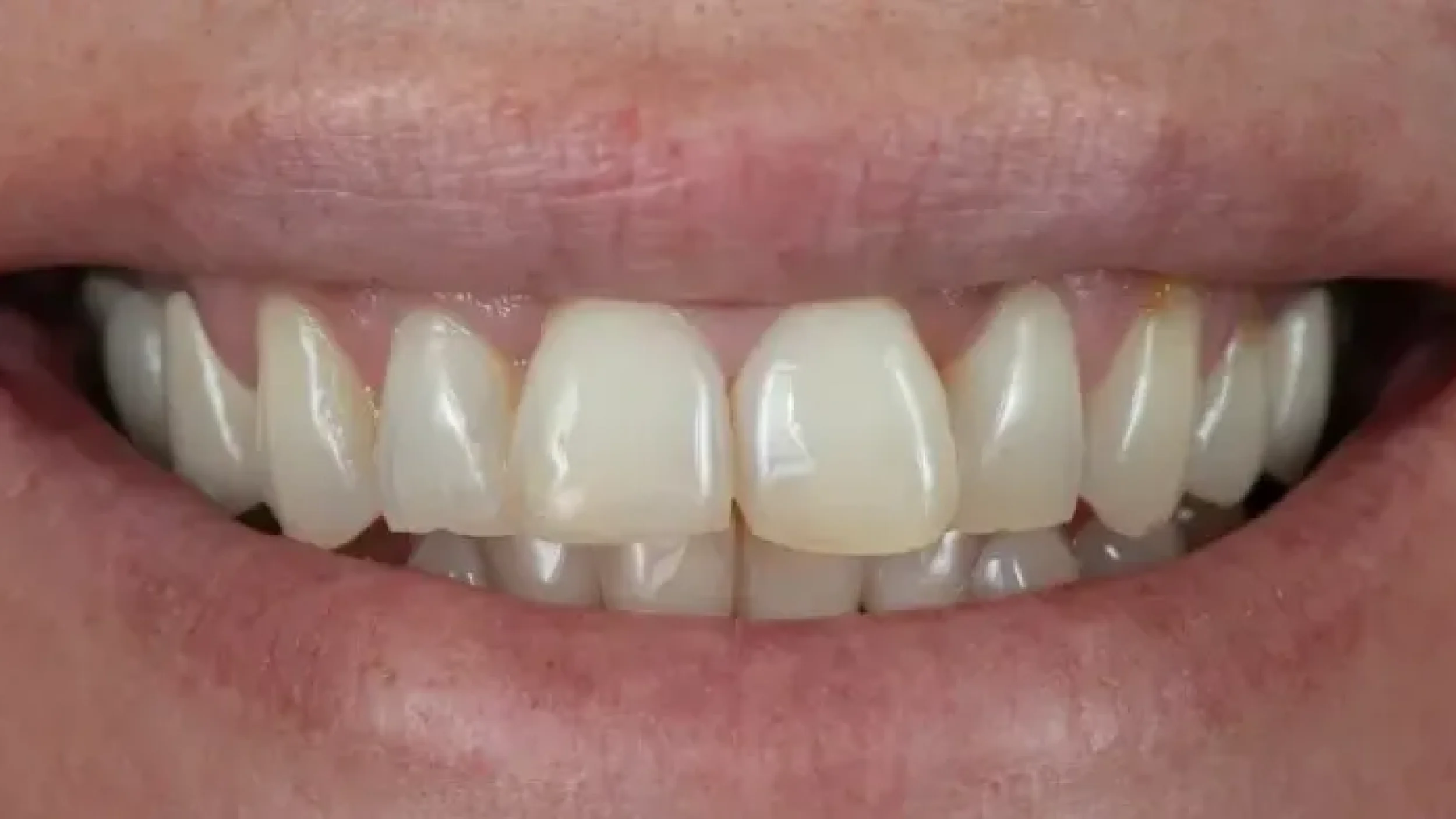 Porcelain Veeners Before After FF at Gordon Dental Implants and Cosmetics
