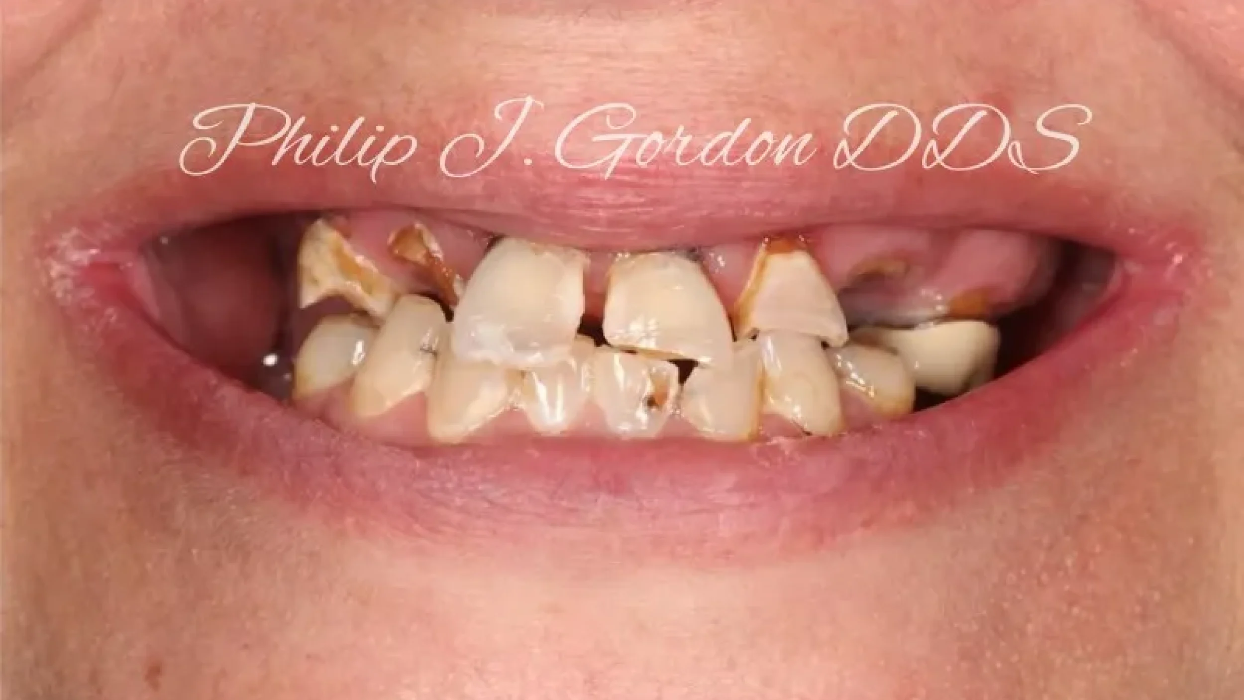 Gordon Dental Implants and Cosmetics Before After G