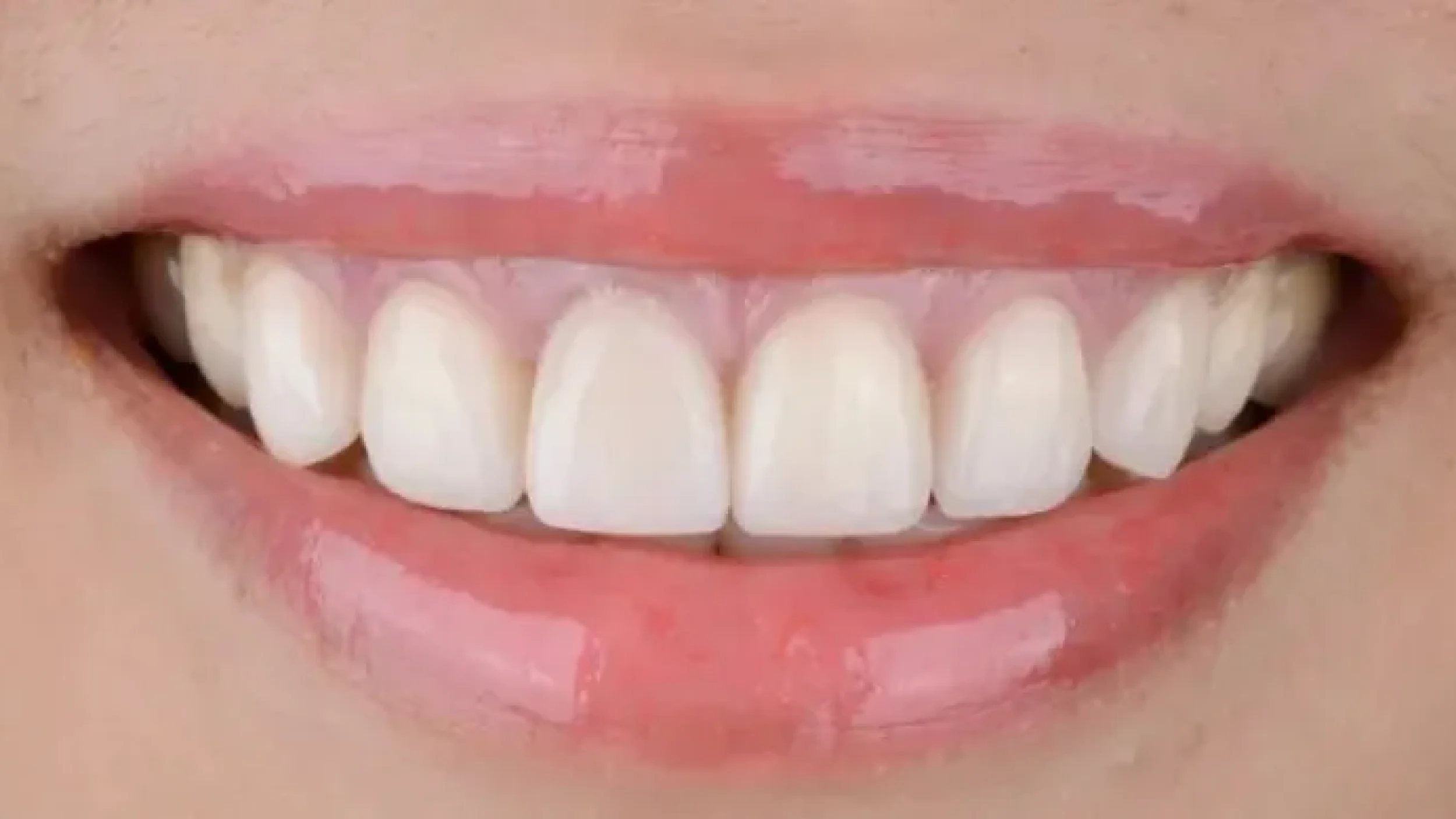 Gordon Dental Implants and Cosmetics Before After HH