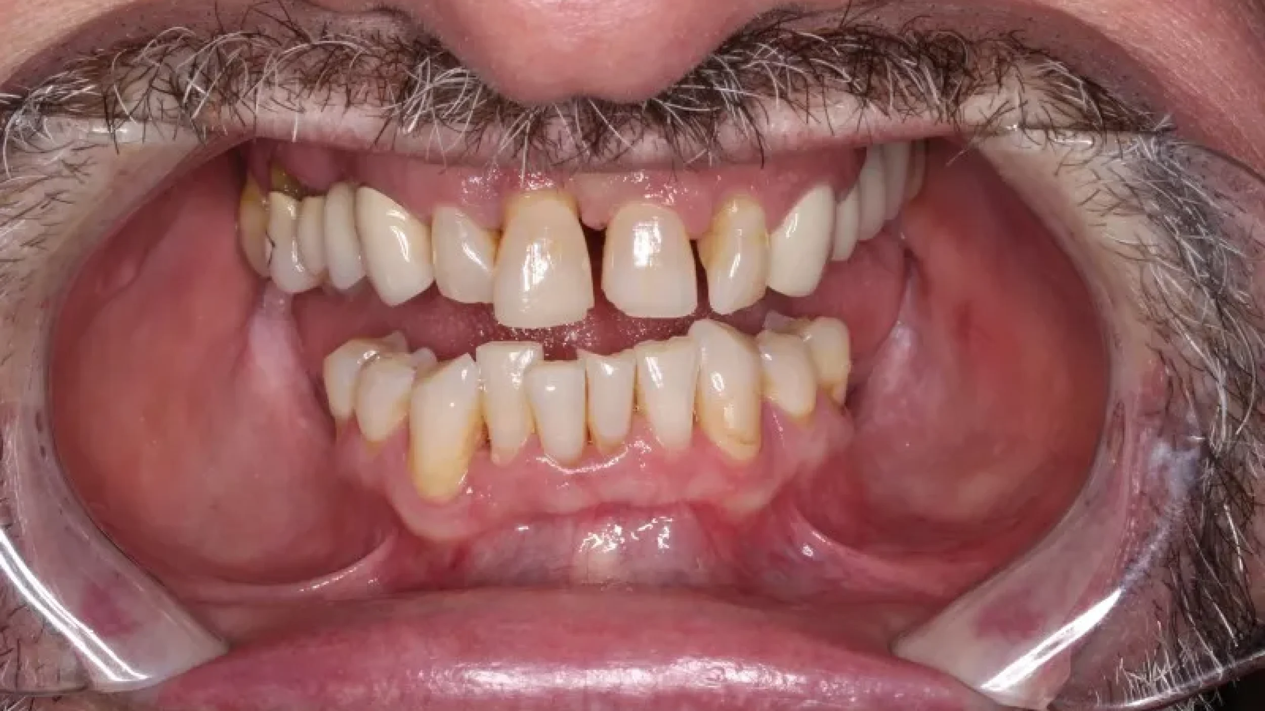 Gordon Dental Implants and Cosmetics Before After I