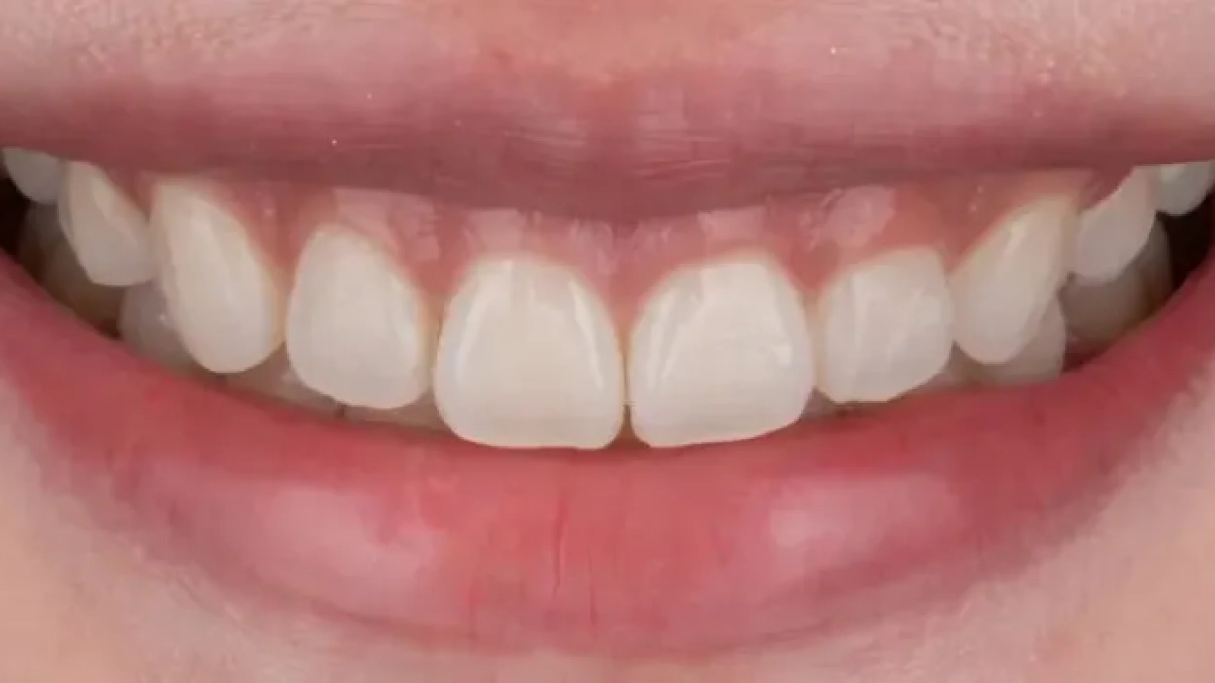 Porcelain Veeners Before After II at Gordon Dental Implants and Cosmetics