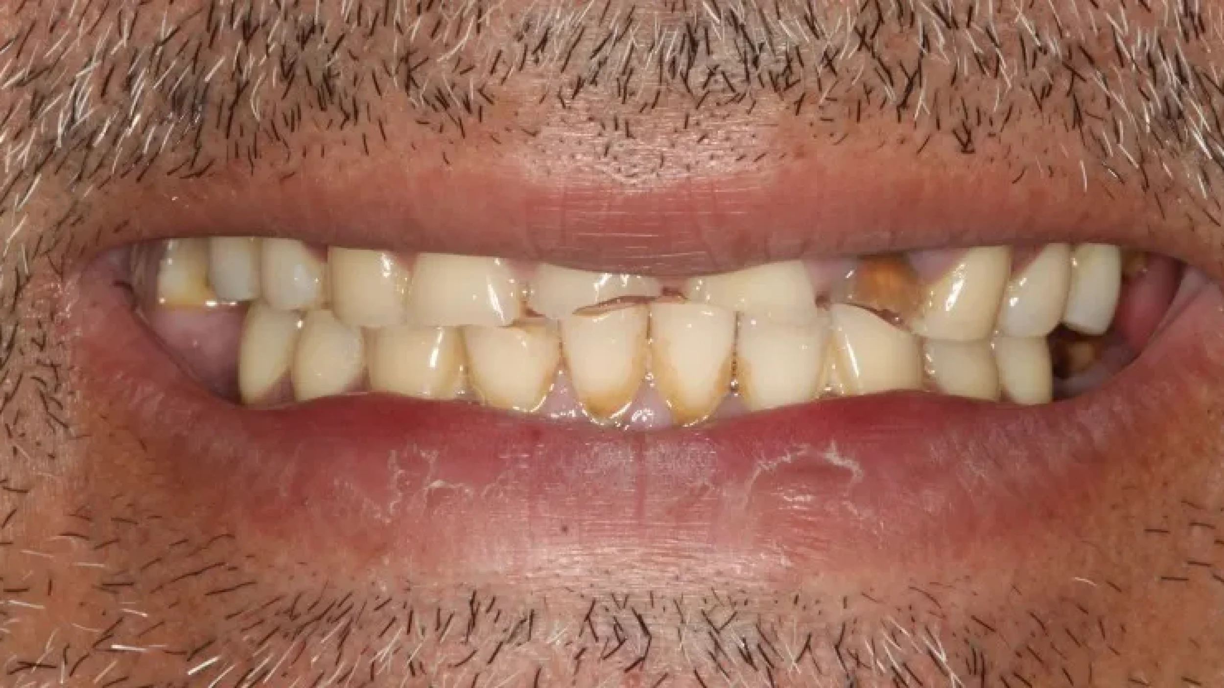 Gordon Dental Implants and Cosmetics Before After J