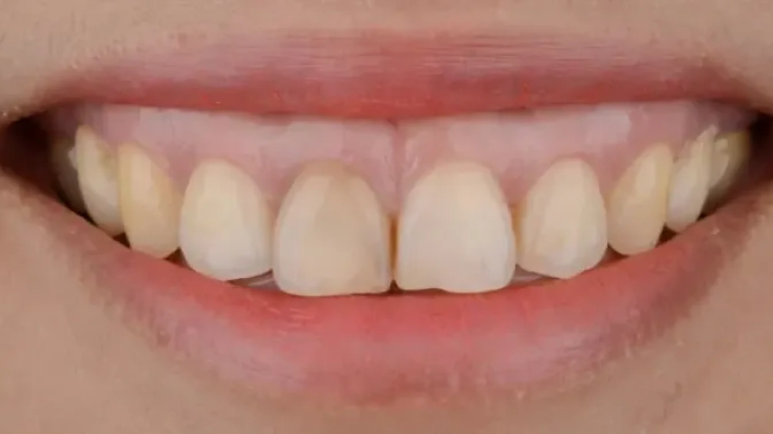 Gordon Dental Implants and Cosmetics porcelain veneer Before After JJ