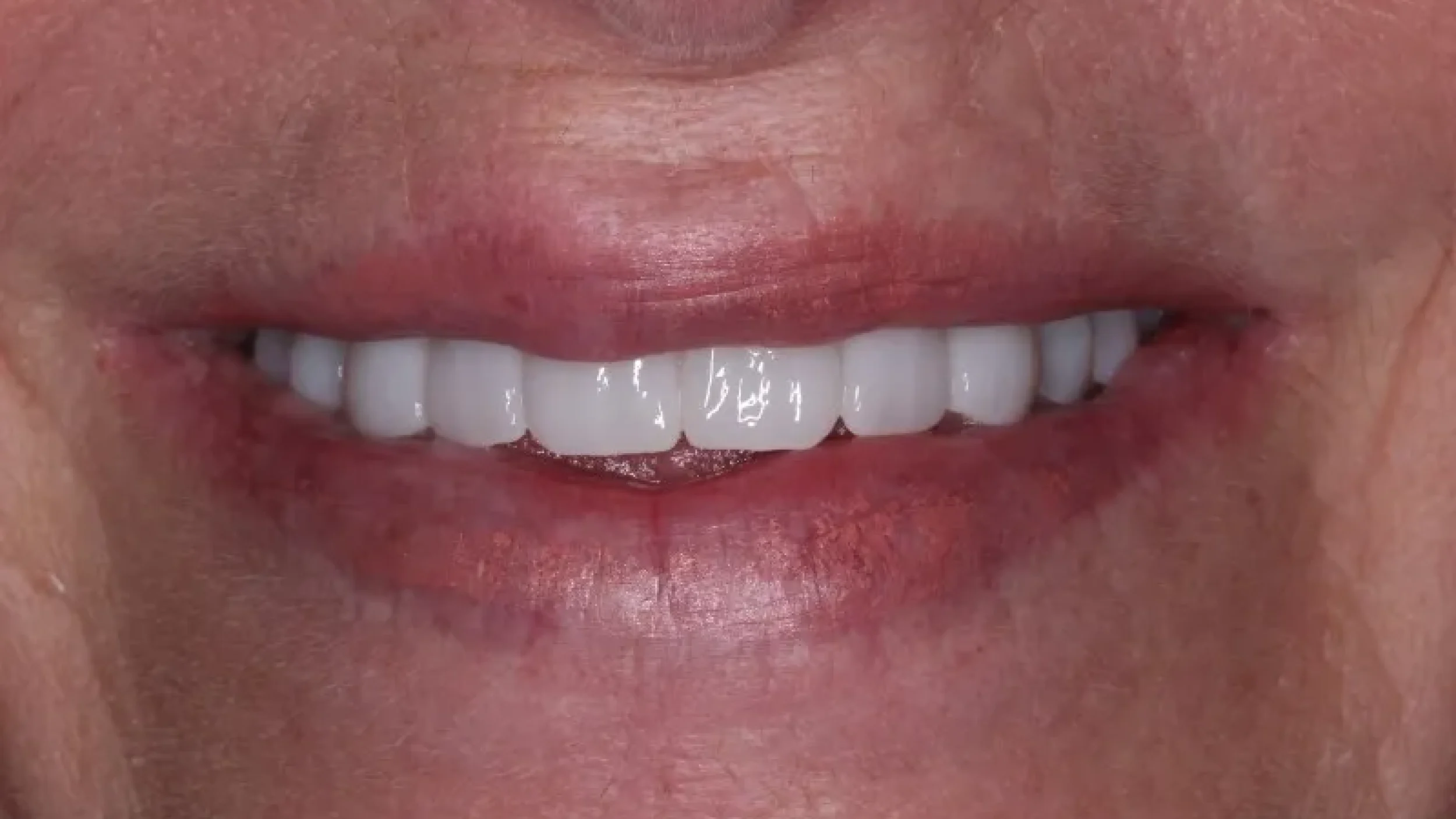 Gordon Dental Implants and Cosmetics Before After K