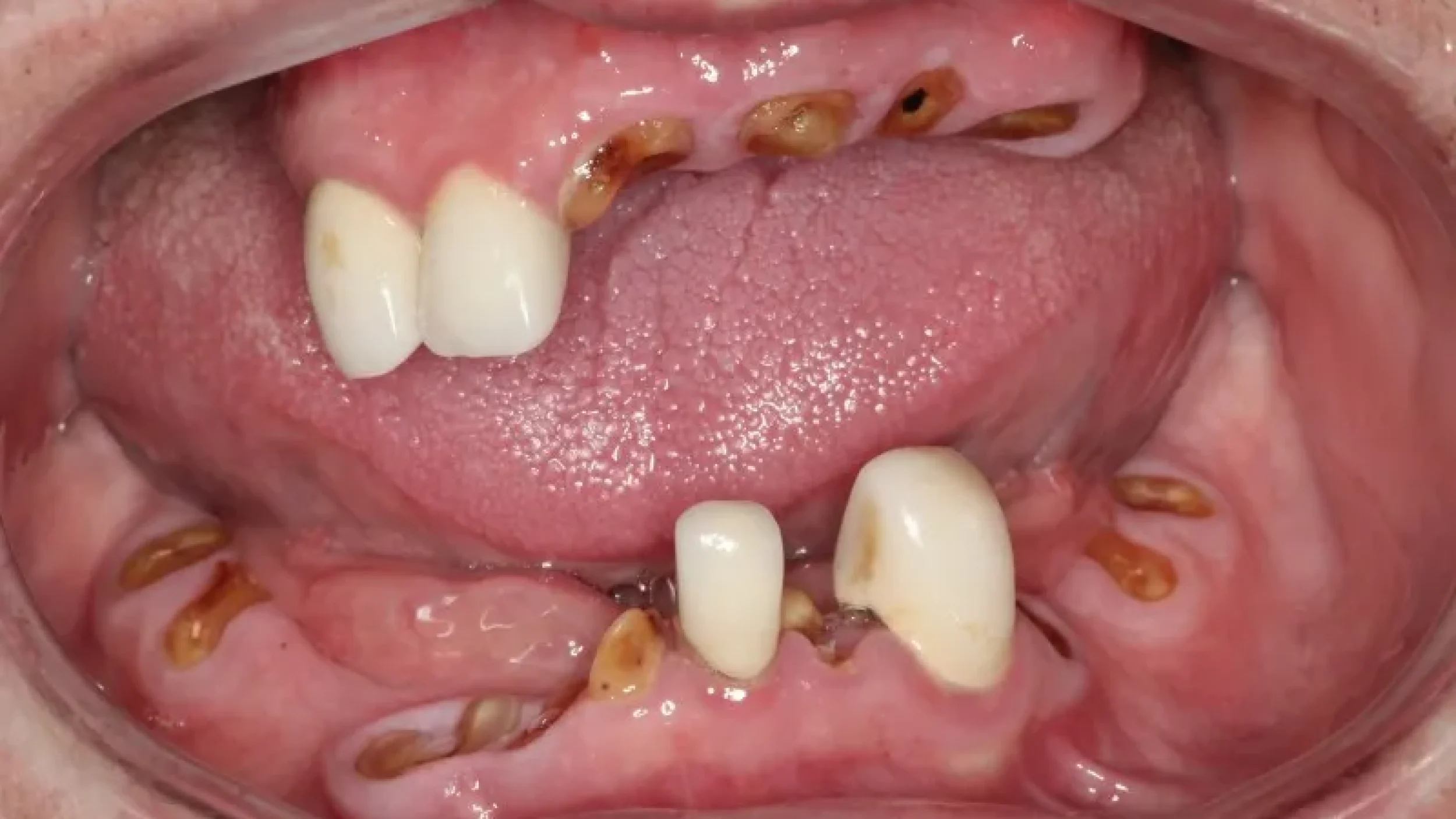 Gordon Dental Implants and Cosmetics Before After 4