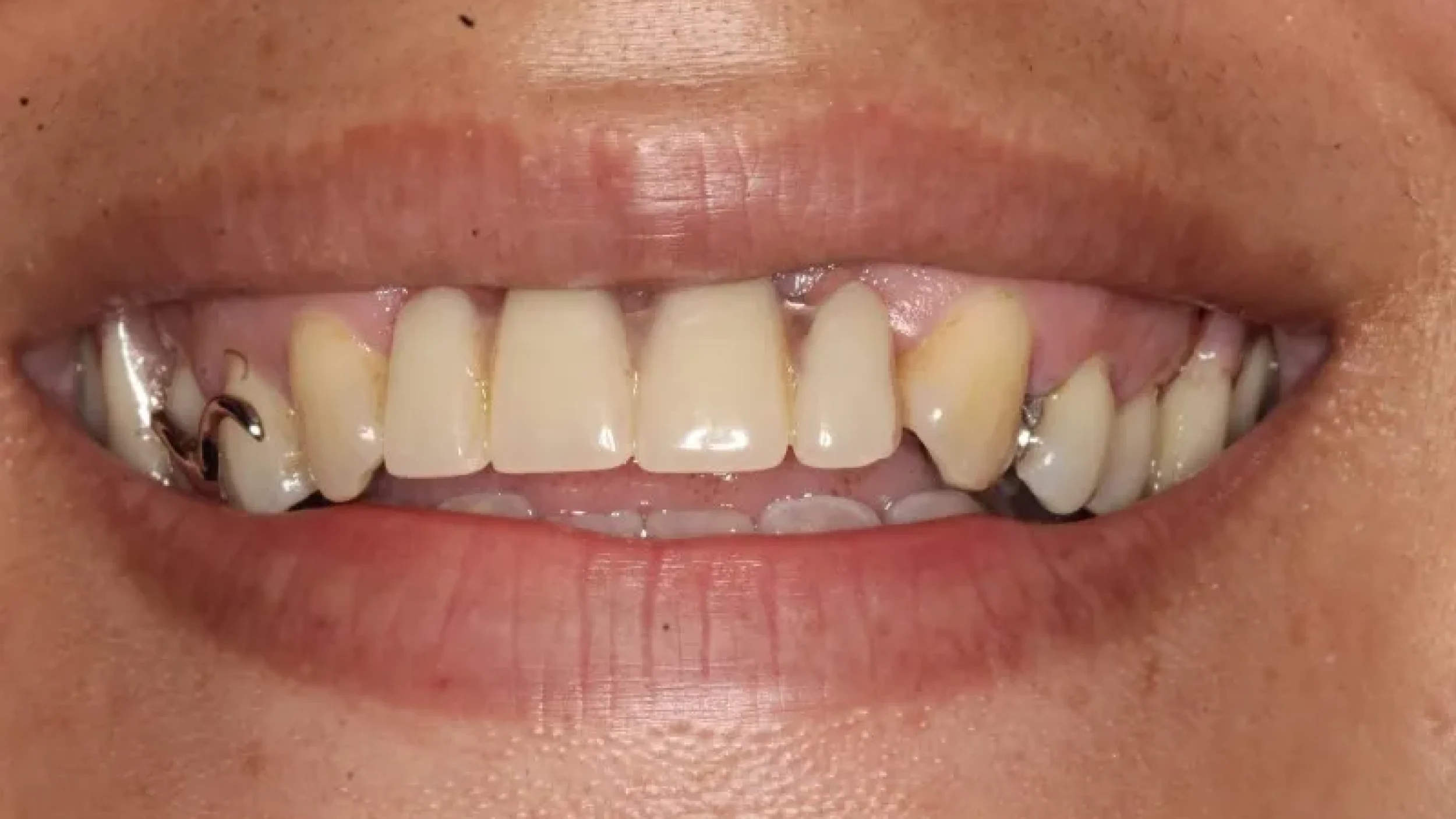 Gordon Dental Implants and Cosmetics Before After N