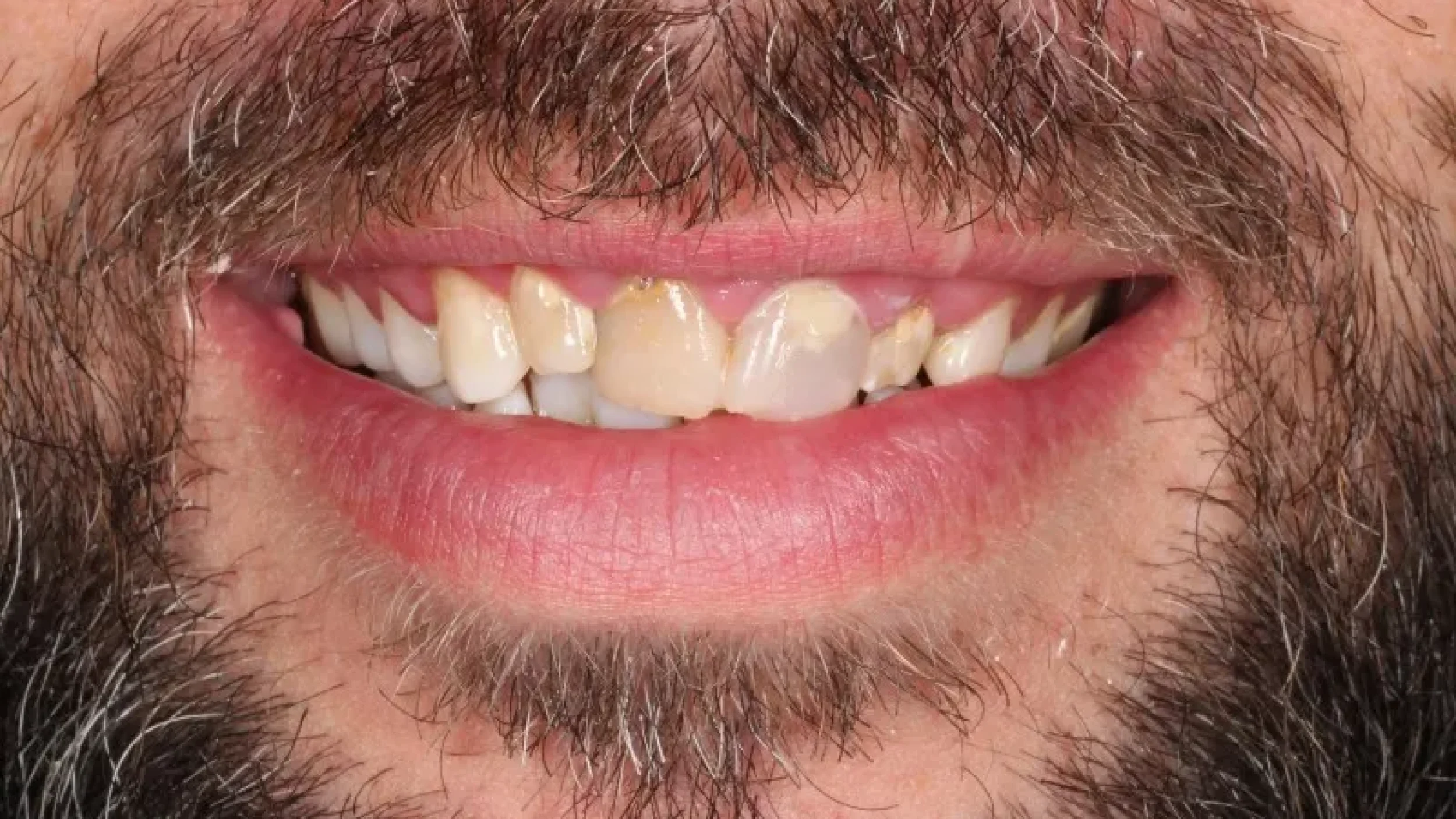 Gordon Dental Implants and Cosmetics Before After N