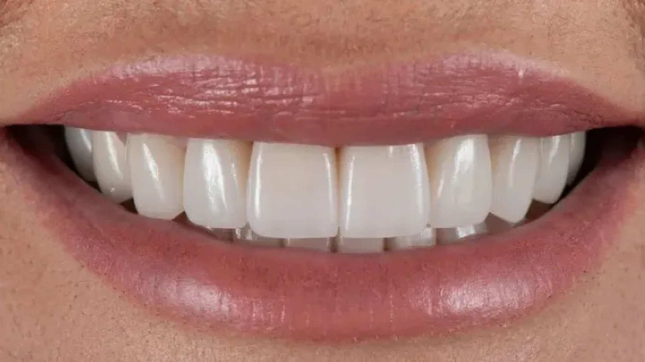 Gordon Dental Implants and Cosmetics Before After D