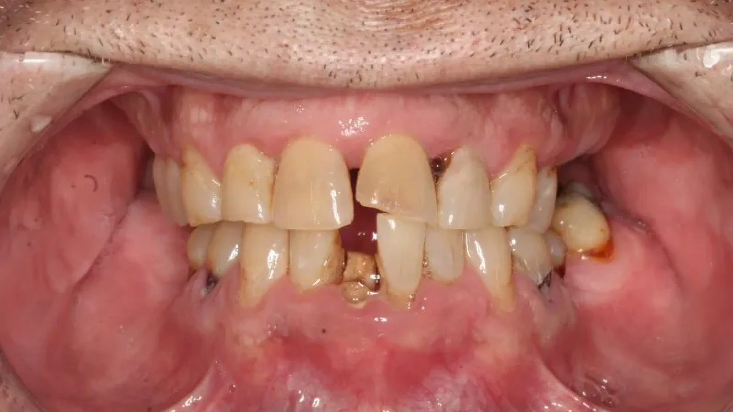 close up of teeth and gums