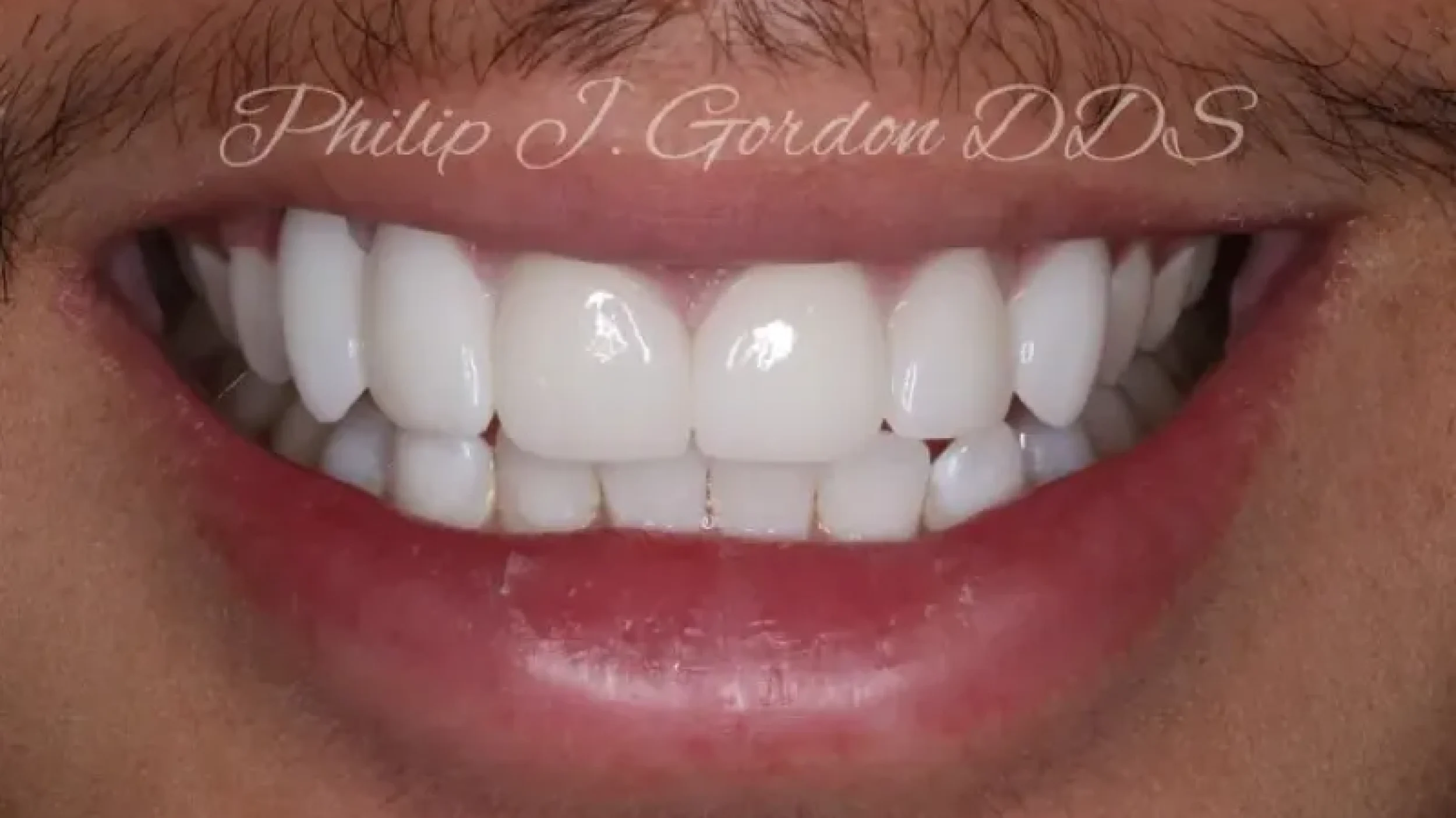 Gordon Dental Implants and Cosmetics Before After QQ