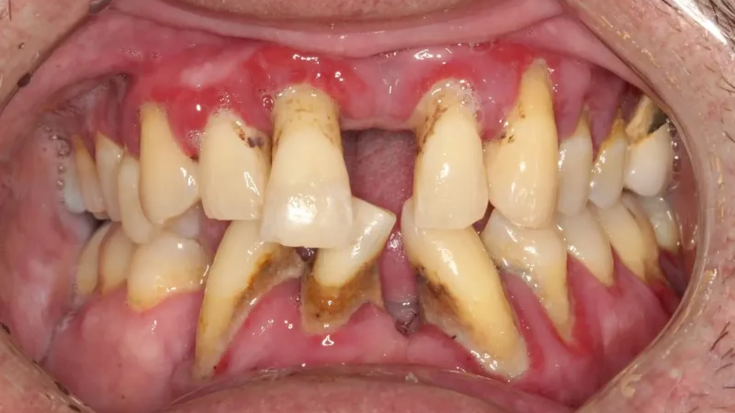 Gordon Dental Implants and Cosmetics Before Treatment