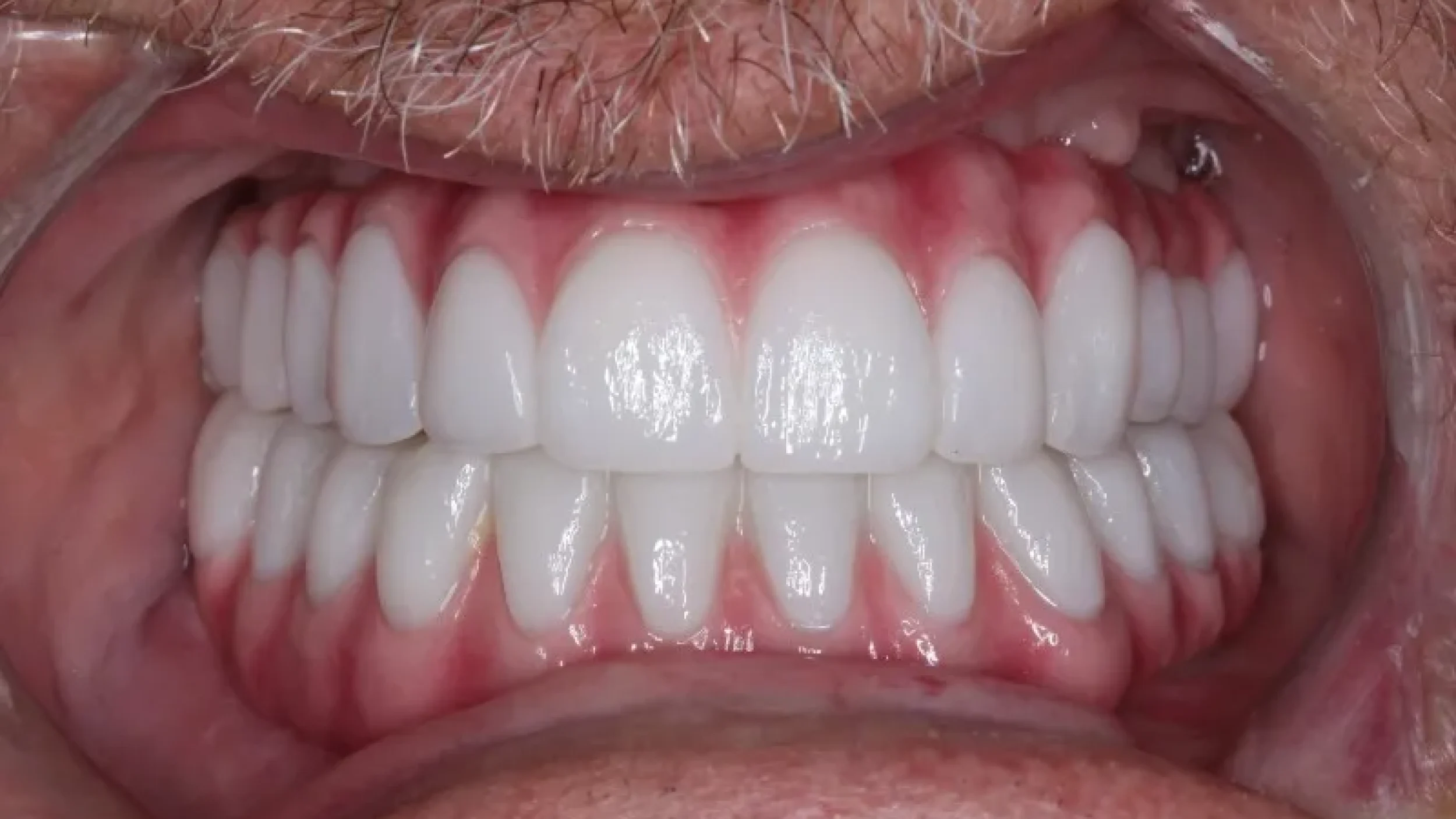 Veneers Before After1 at Gordon Dental Implants and Cosmetics