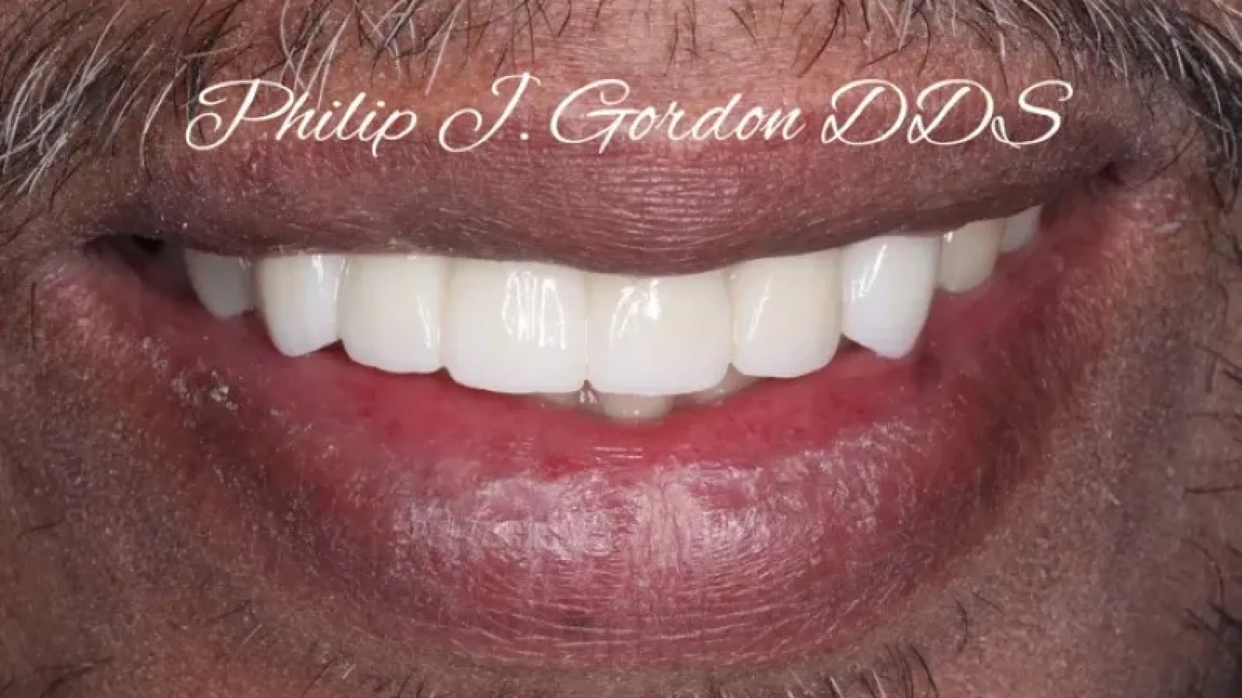 Gordon Dental Implants and Cosmetics Before After SS