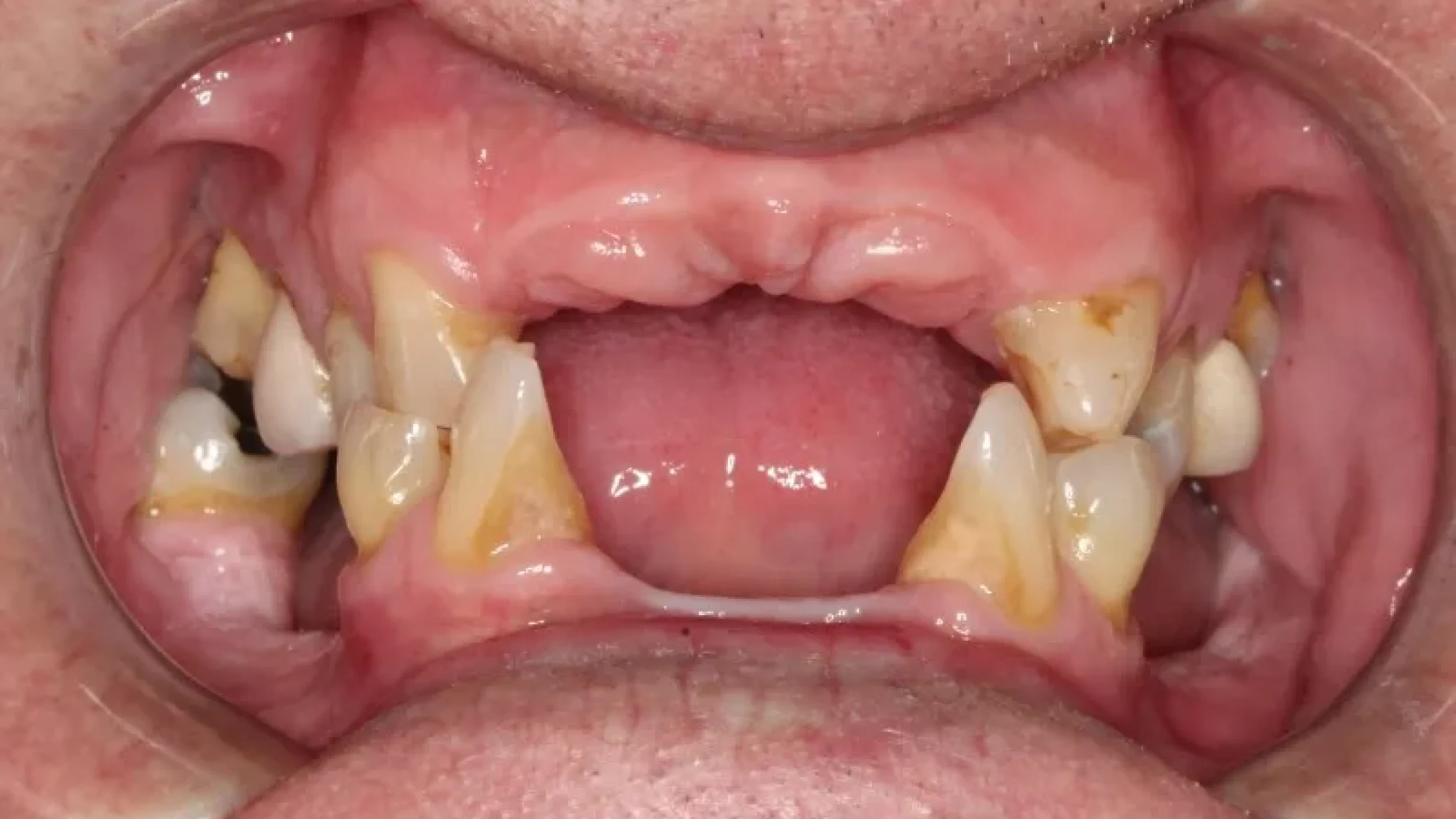 Veneers Before at Gordon Dental Implants and Cosmetics