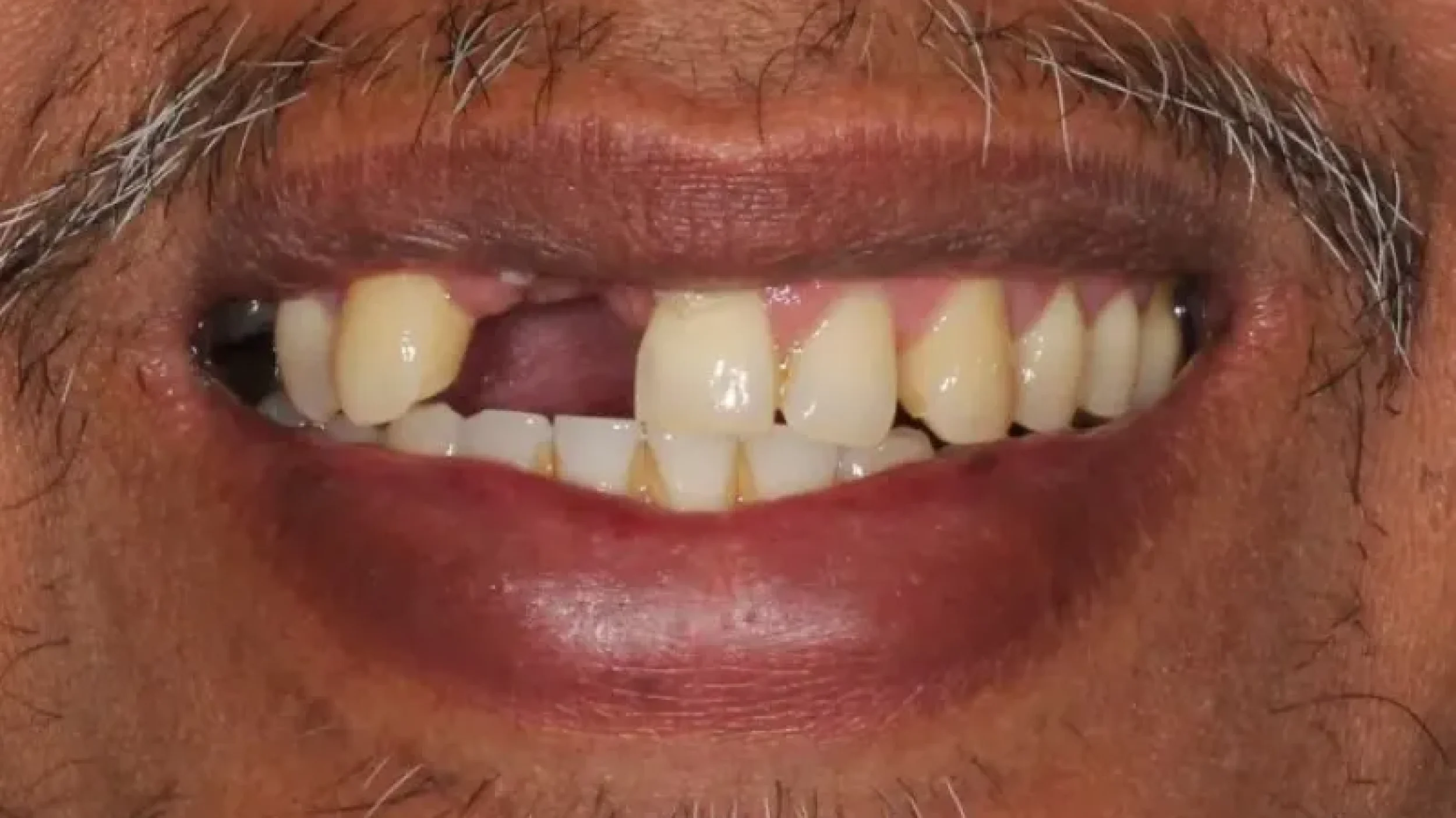 Gordon Dental Implants and Cosmetics Before After TT