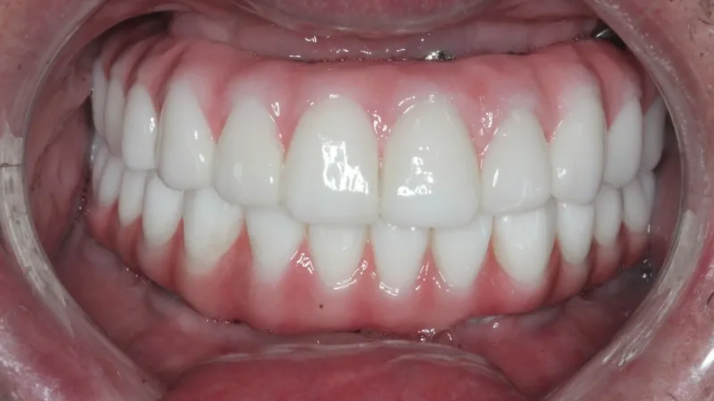 Veneers Before After at Gordon Dental Implants and Cosmetics