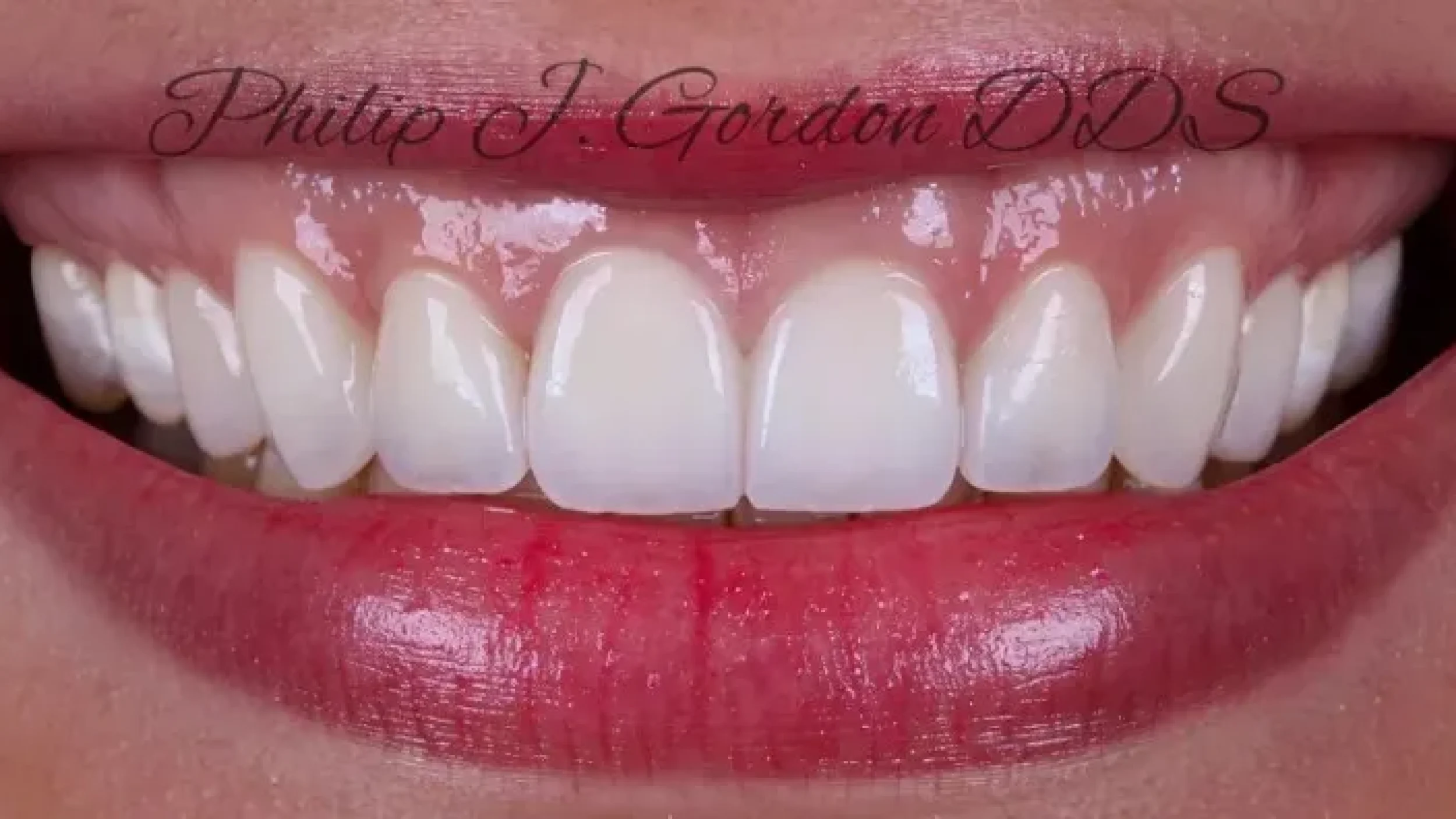 Gordon Dental Implants and Cosmetics Before After UU