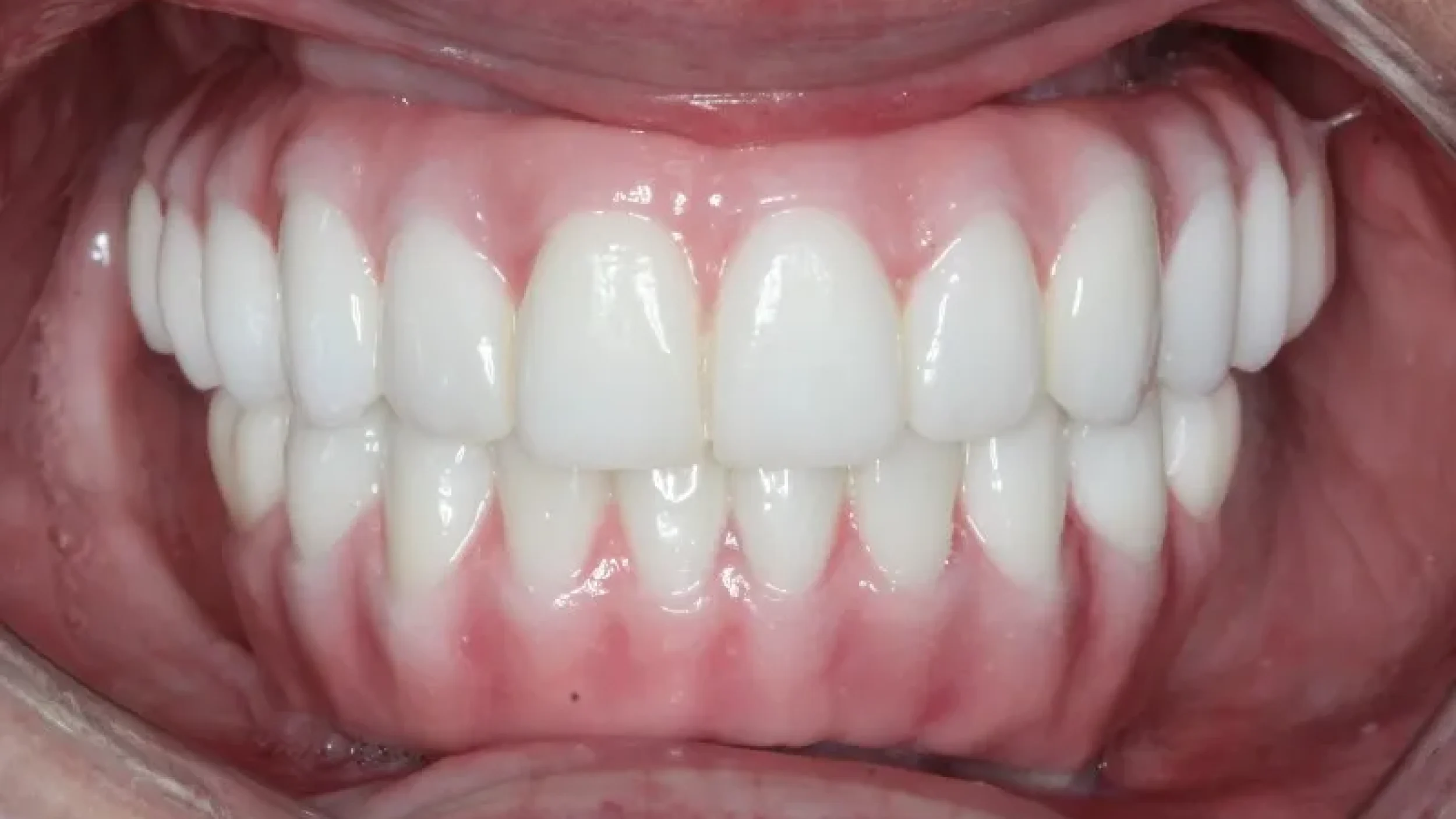 Gordon Dental Implants and Cosmetics Veneers Before After