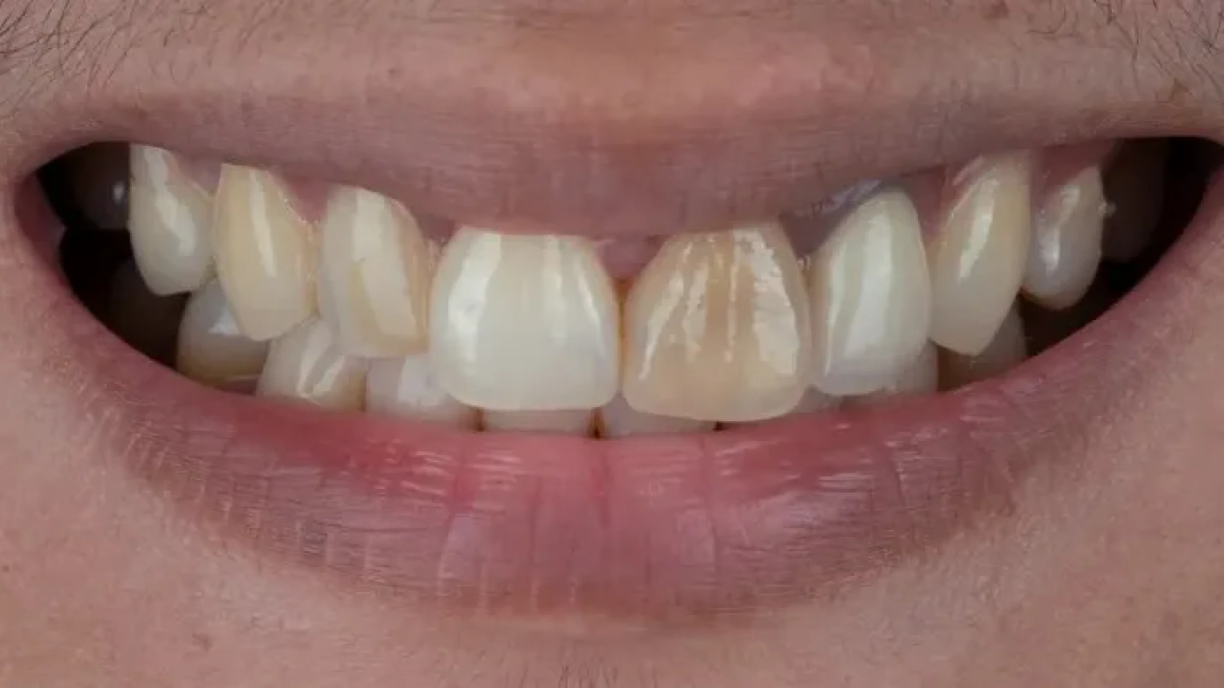 Gordon Dental Implants and Cosmetics porcelain veneers Before After WW